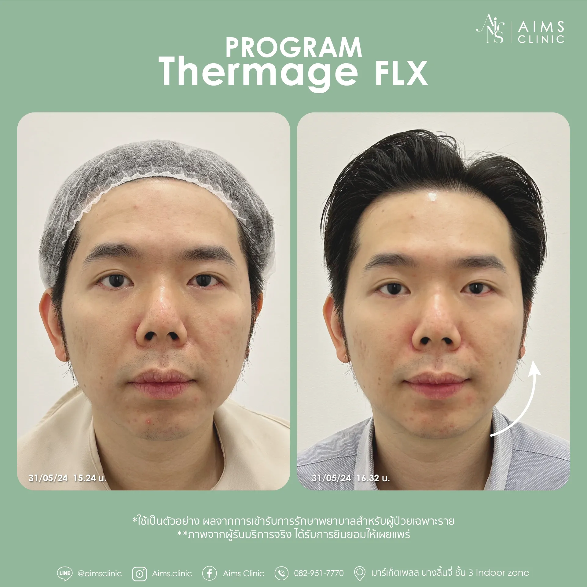 Before and after photos: Program Thermage FLX, โปรแกรม Thermage FLX