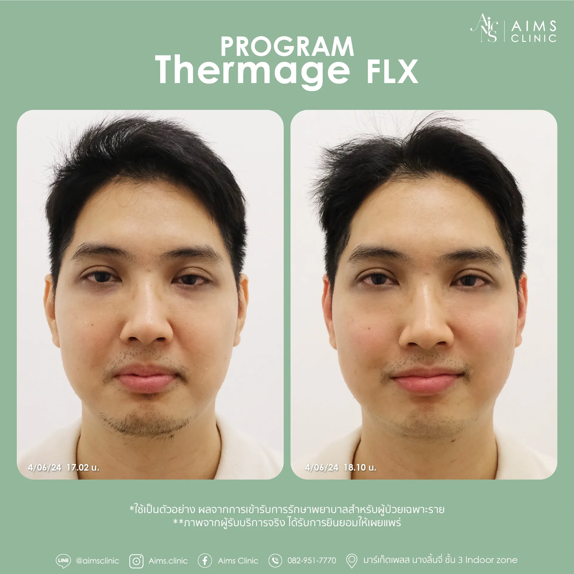 Before and after photos: Program Thermage FLX, โปรแกรม Thermage FLX