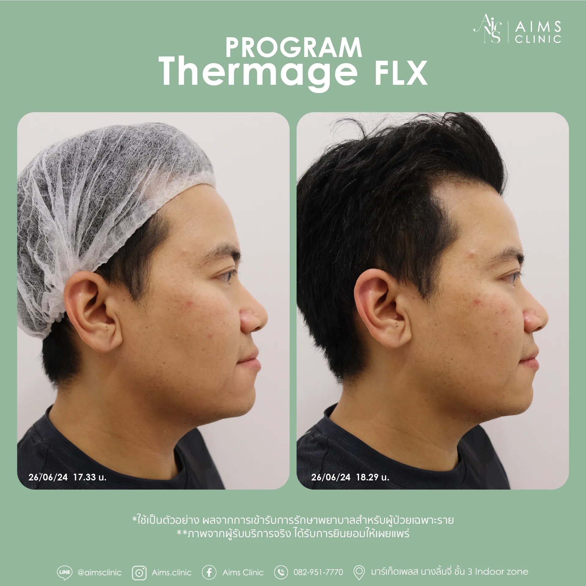 Before and after photos: โปรแกรม Thermage FLX