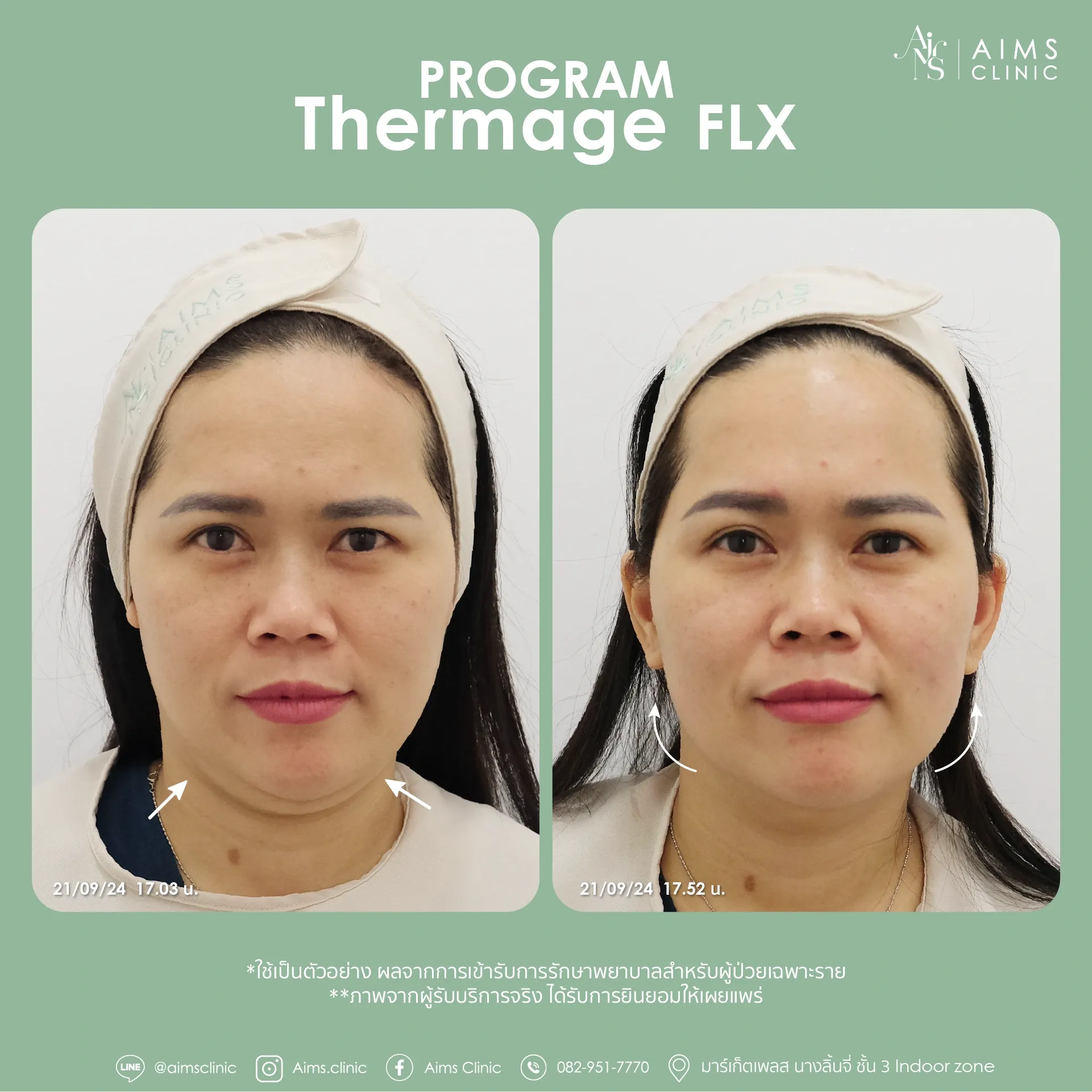 Before and after photos: โปรแกรม Thermage FLX