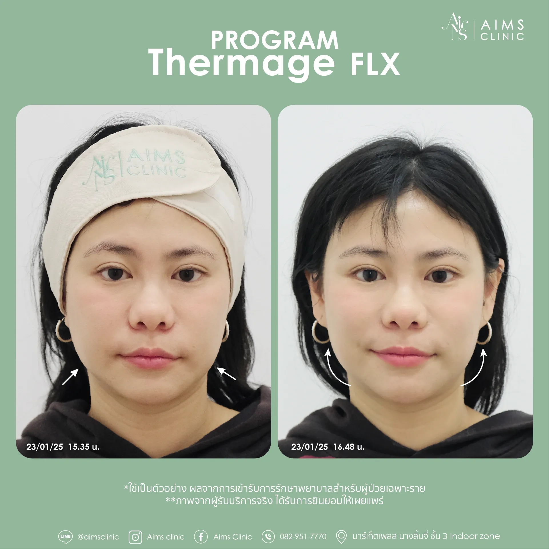 Before and after photos: Program Thermage FLX, โปรแกรม Thermage FLX