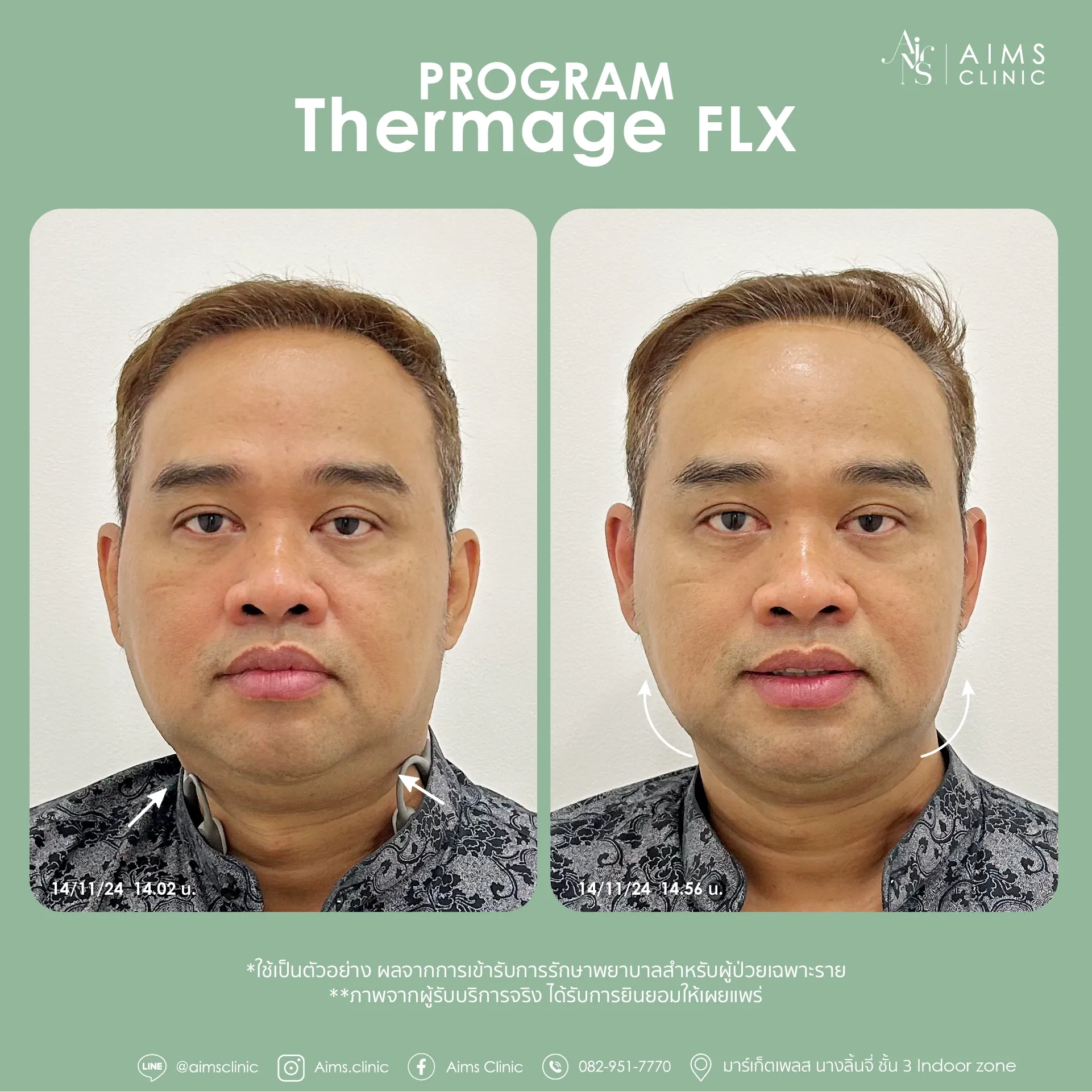 Before and after photos: Program Thermage FLX, โปรแกรม Thermage FLX
