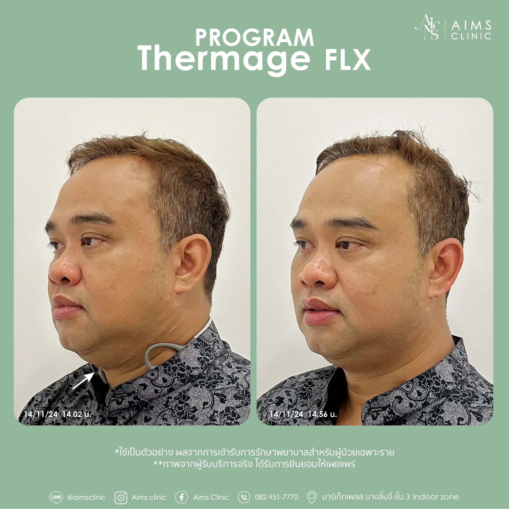 Before and after photos: Program Thermage FLX, โปรแกรม Thermage FLX