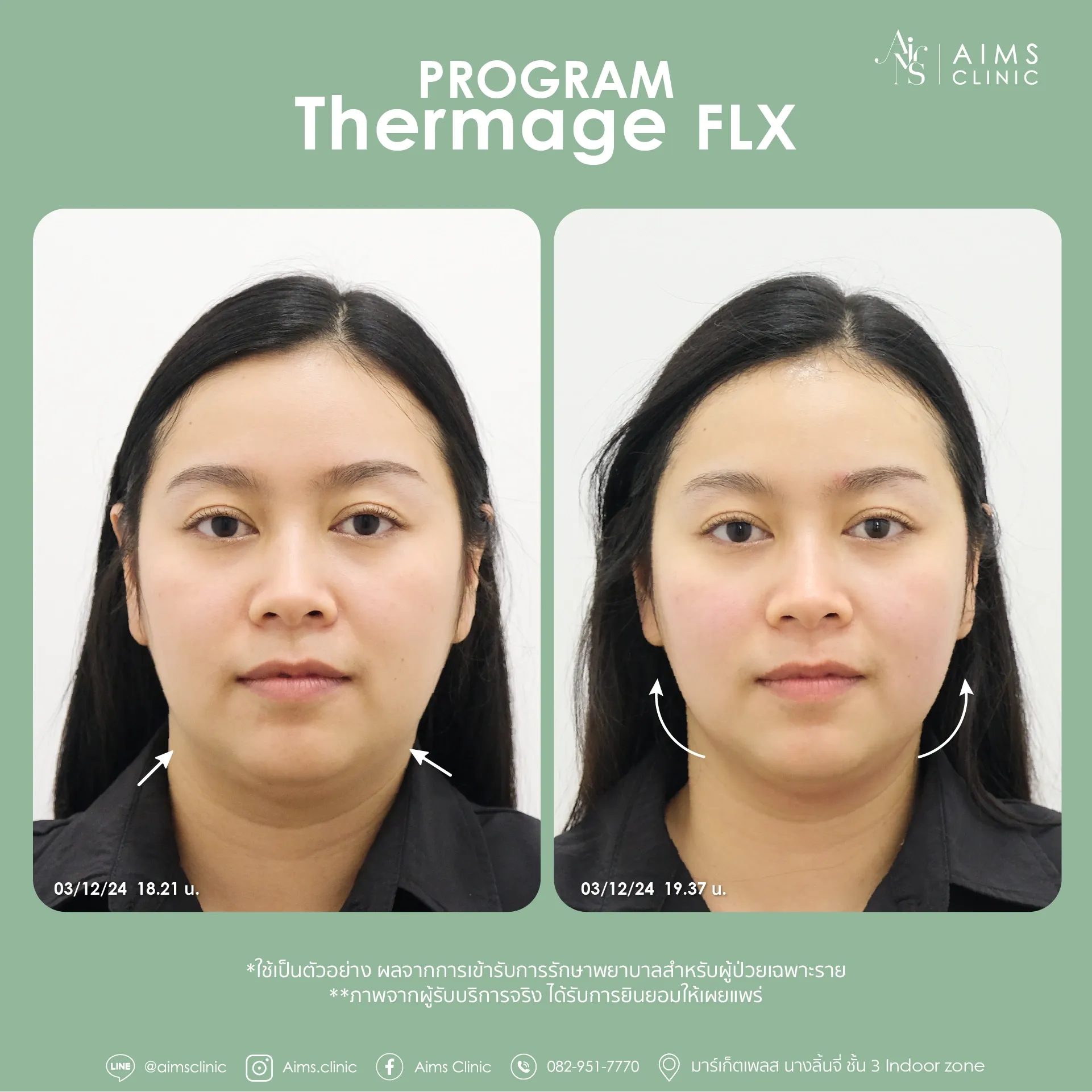 Before and after photos: Program Thermage FLX, โปรแกรม Thermage FLX