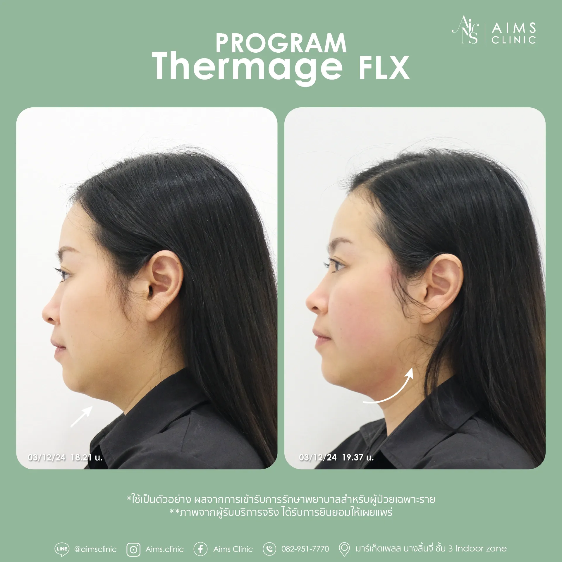 Before and after photos: โปรแกรม Thermage FLX
