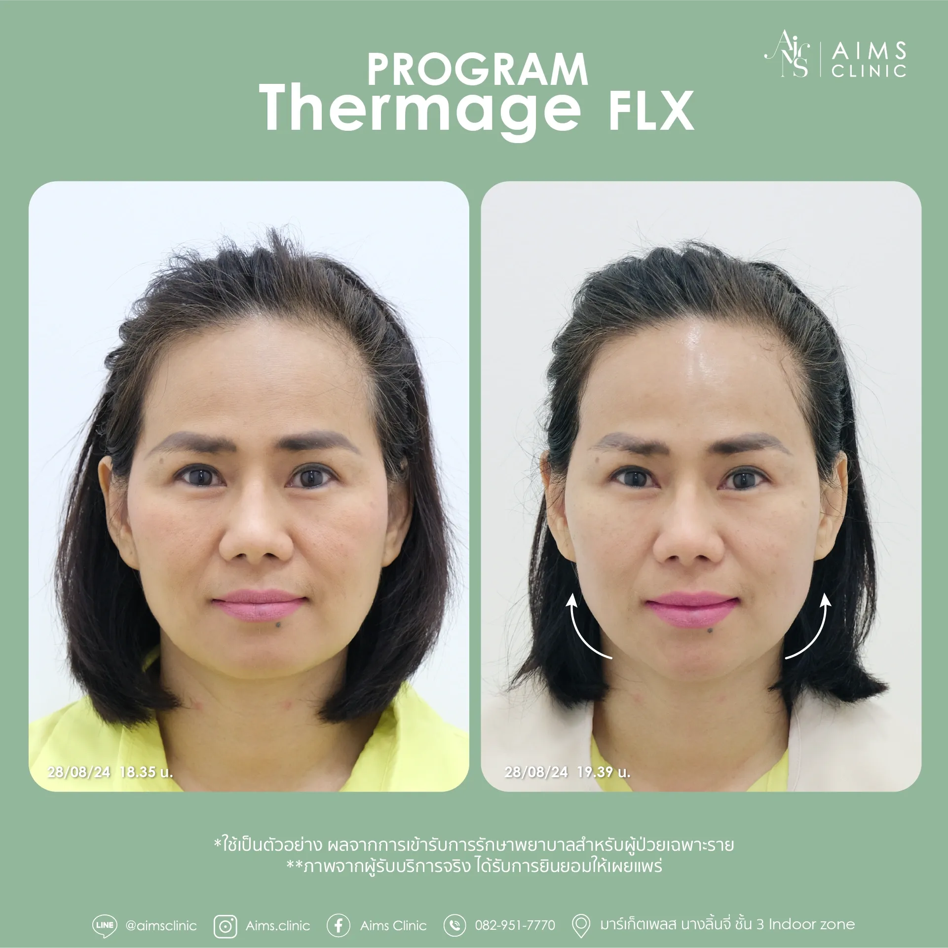 Before and after photos: Program Thermage FLX, โปรแกรม Thermage FLX