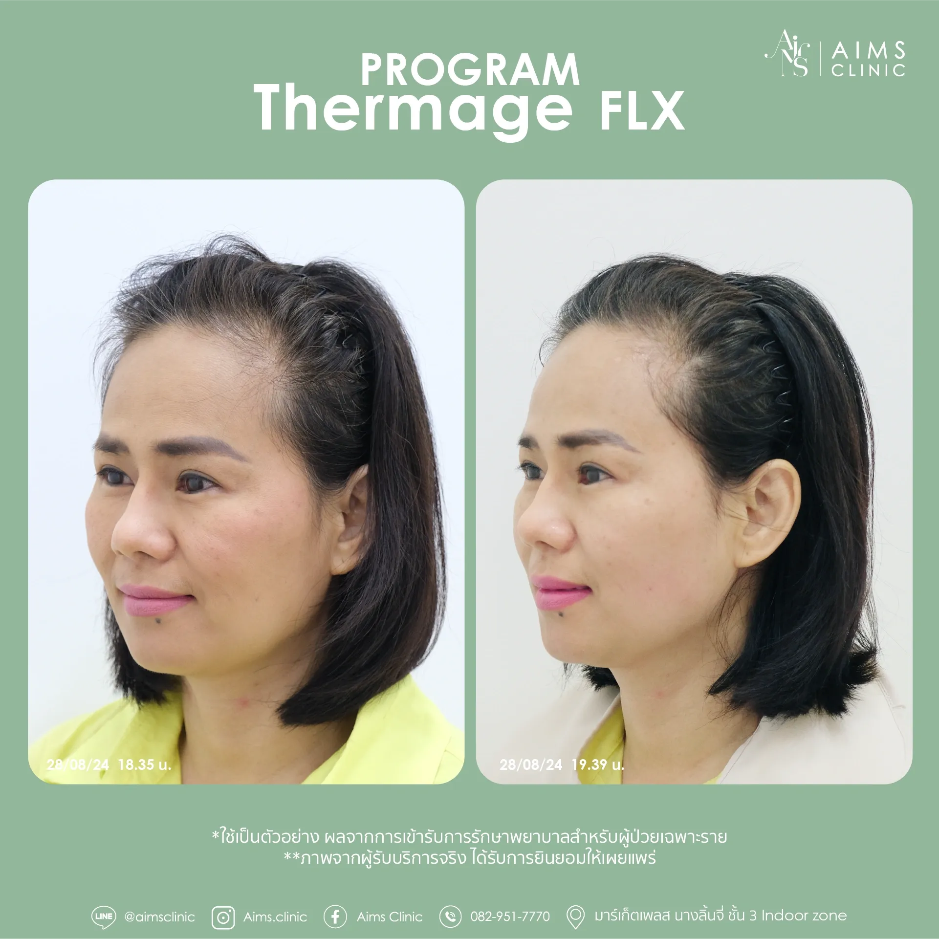 Before and after photos: Program Thermage FLX, โปรแกรม Thermage FLX