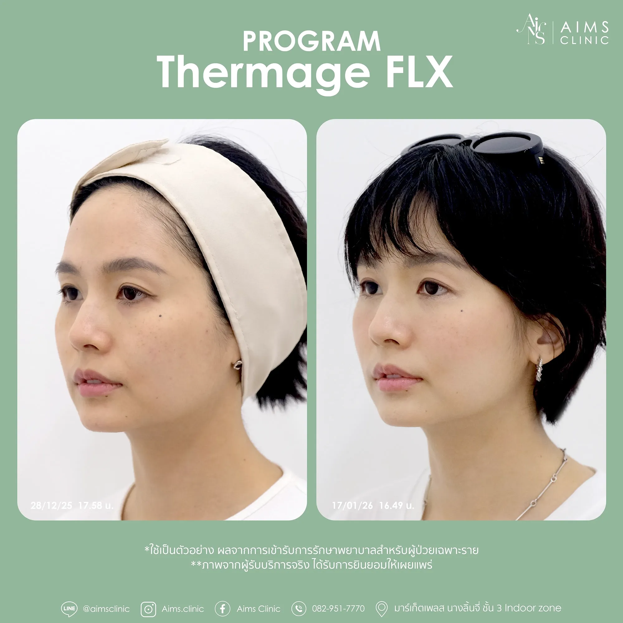 Before and after photos: โปรแกรม Thermage FLX