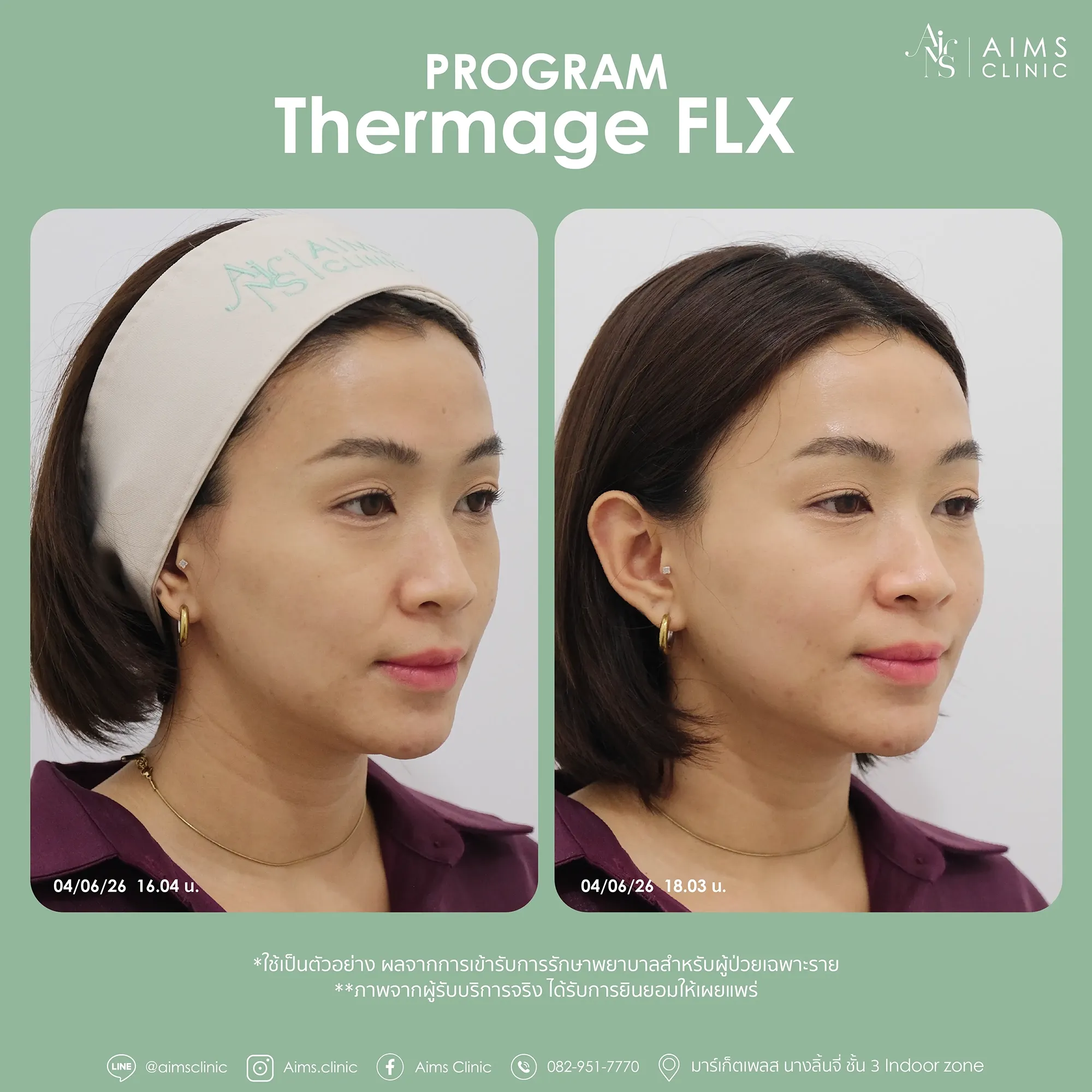 Before and after photos: Program Thermage FLX, โปรแกรม Thermage FLX