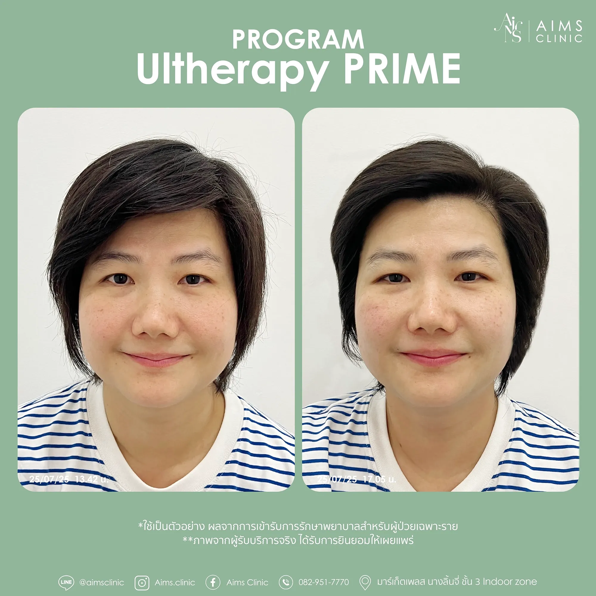 Before and after photos: Program Ultherapy Prime, โปรแกรม Ultherapy Prime