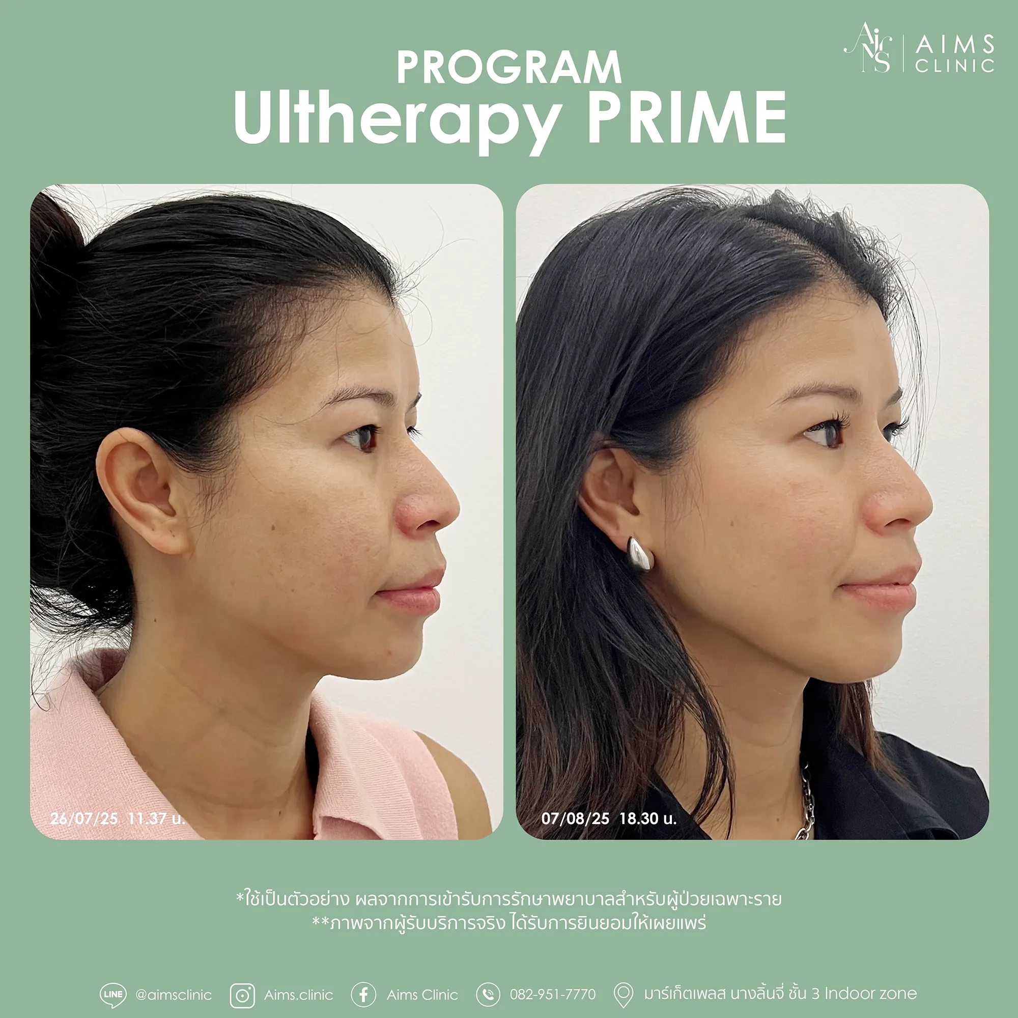 Before and after photos: โปรแกรม Ultherapy Prime