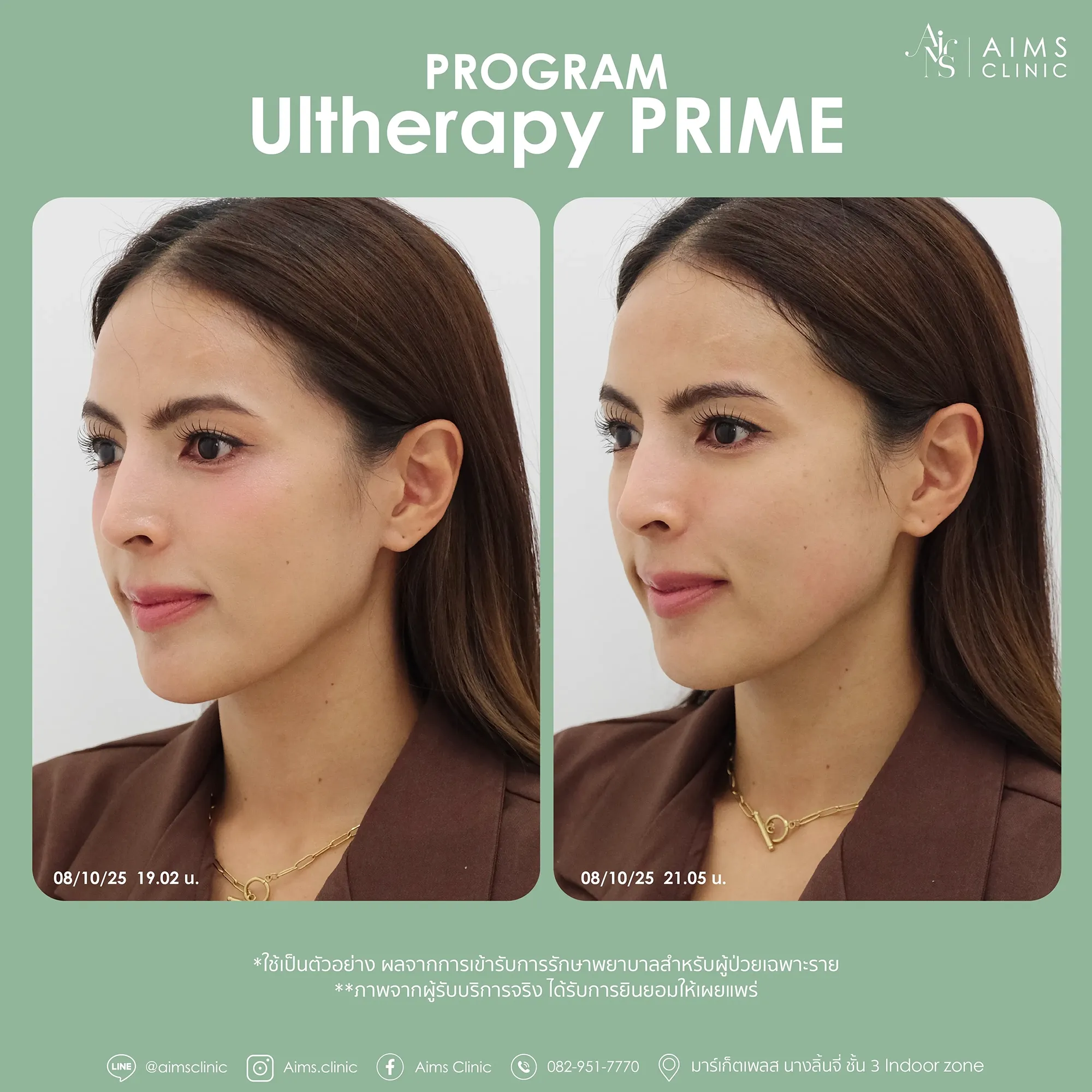 Before and after photos: Program Ultherapy Prime, โปรแกรม Ultherapy Prime