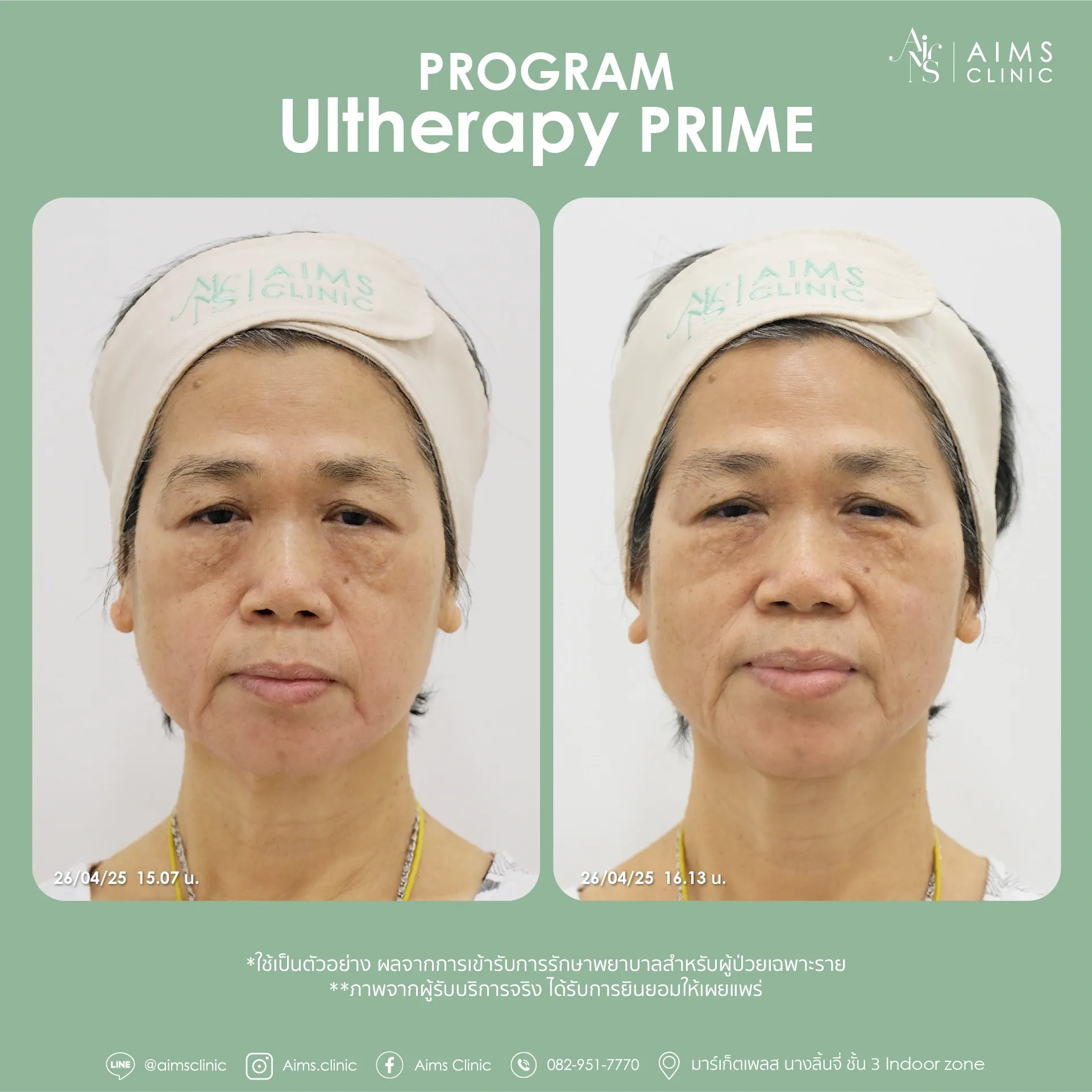 Before and after photos: โปรแกรม Ultherapy Prime