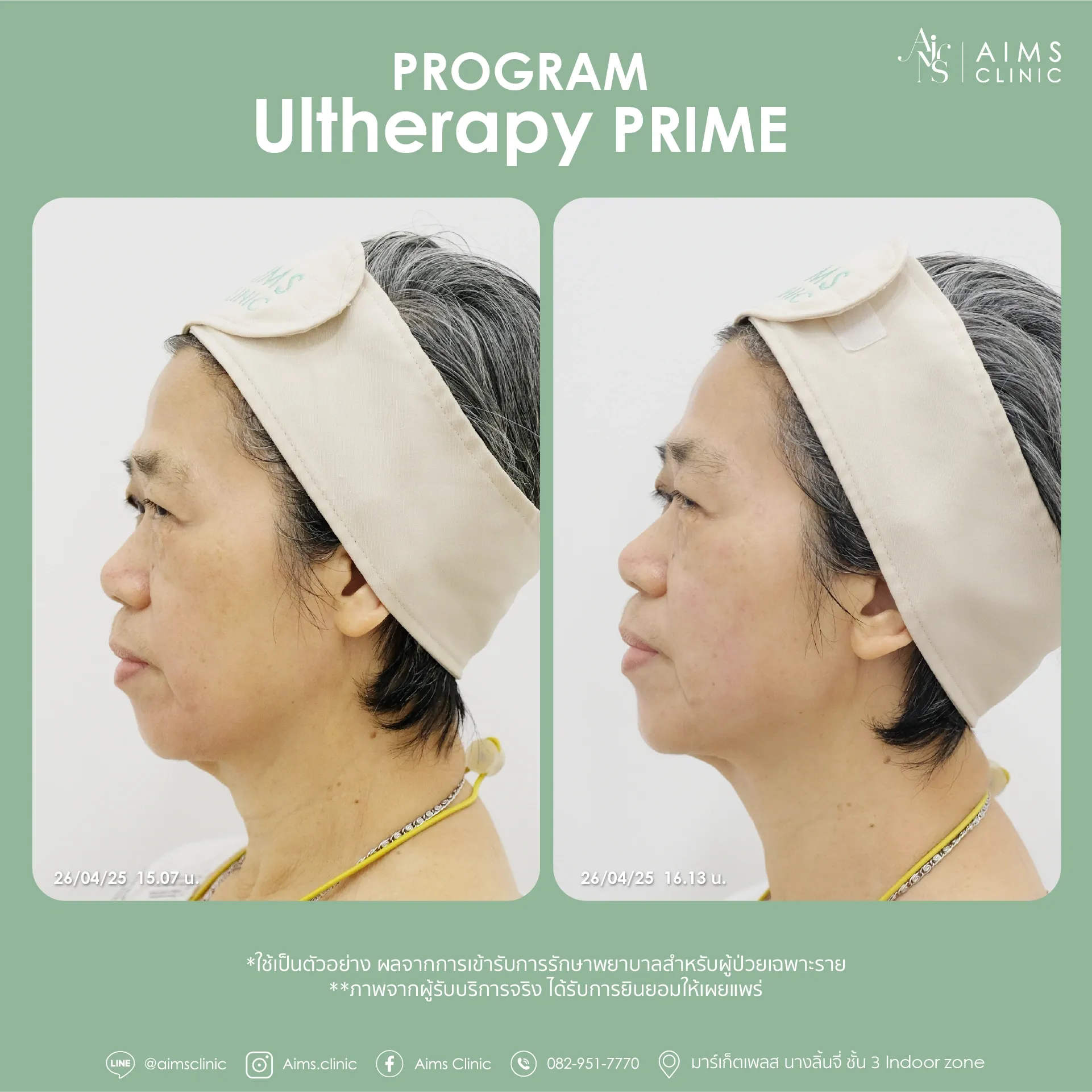 Before and after photos: Program Ultherapy Prime, โปรแกรม Ultherapy Prime