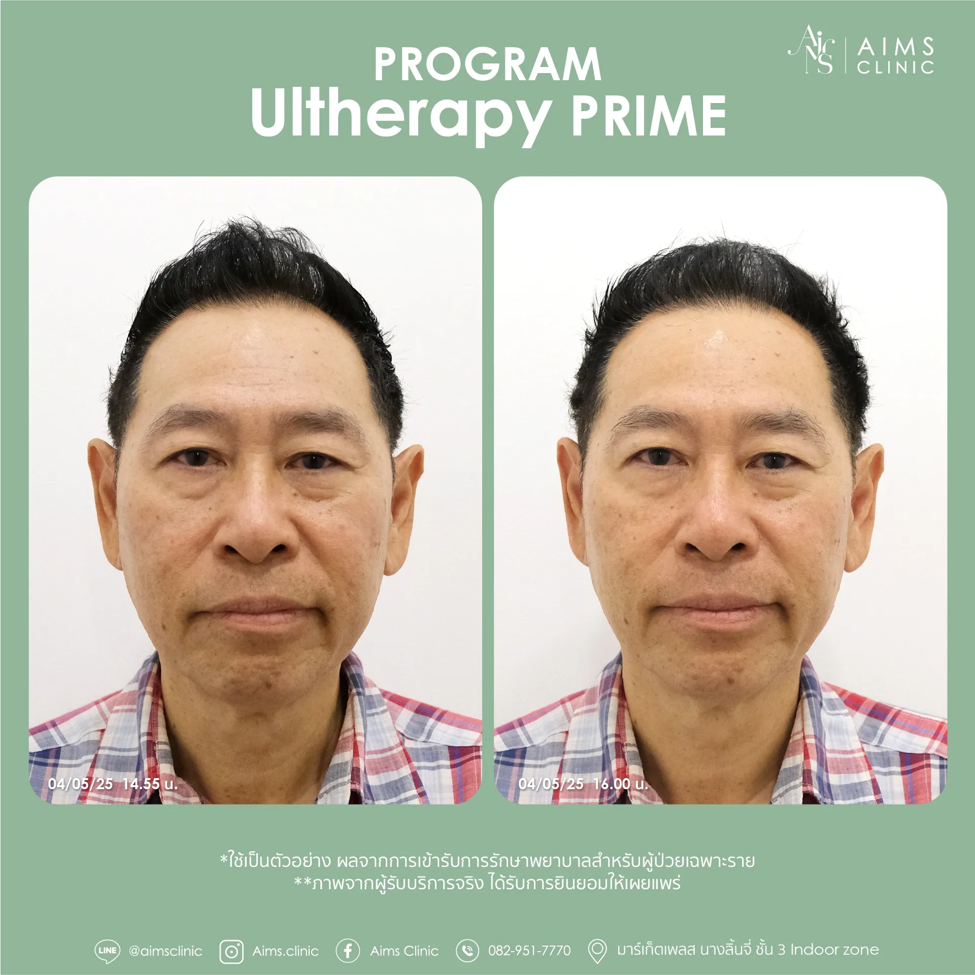 Before and after photos: โปรแกรม Ultherapy Prime