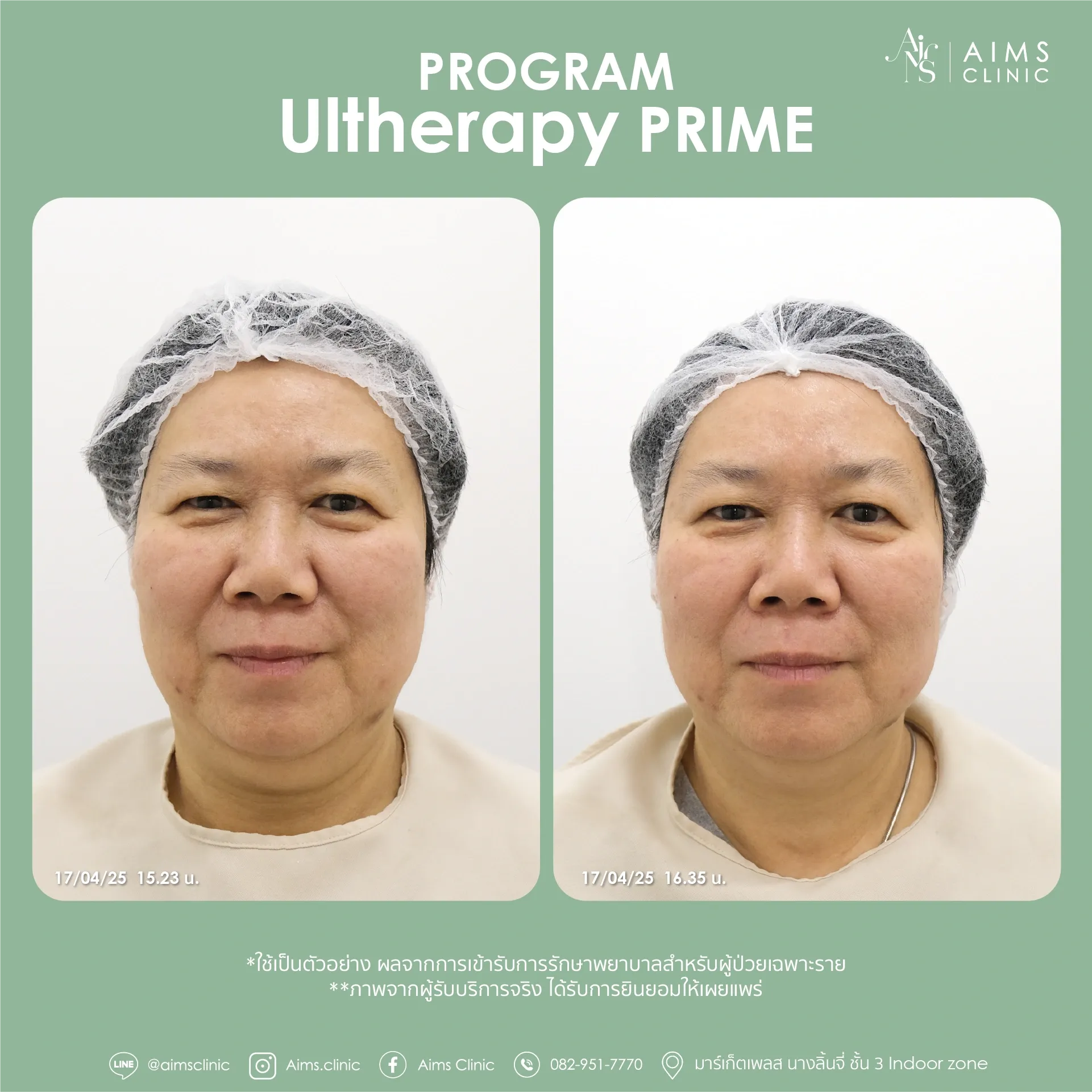 Before and after photos: โปรแกรม Ultherapy Prime