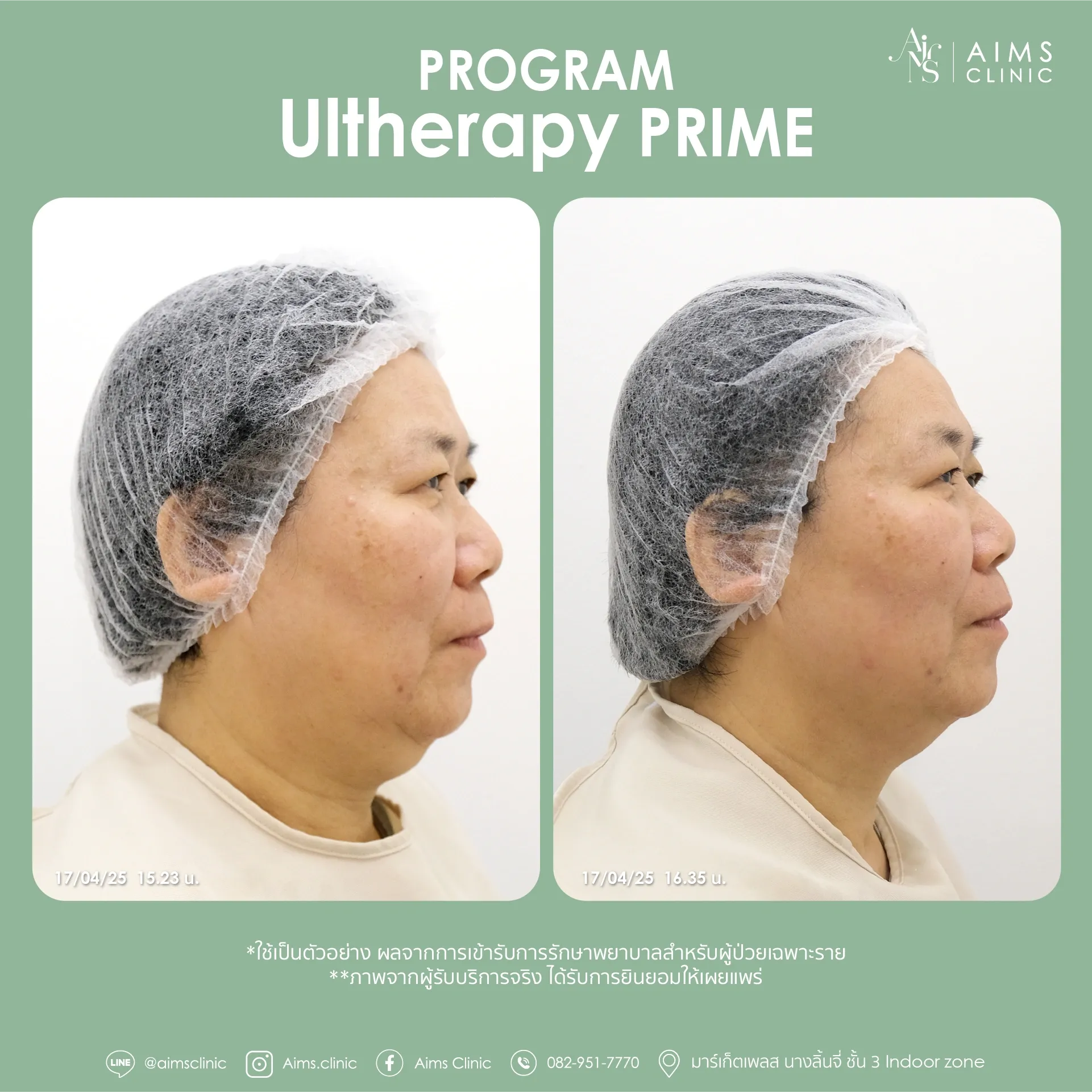 Before and after photos: โปรแกรม Ultherapy Prime