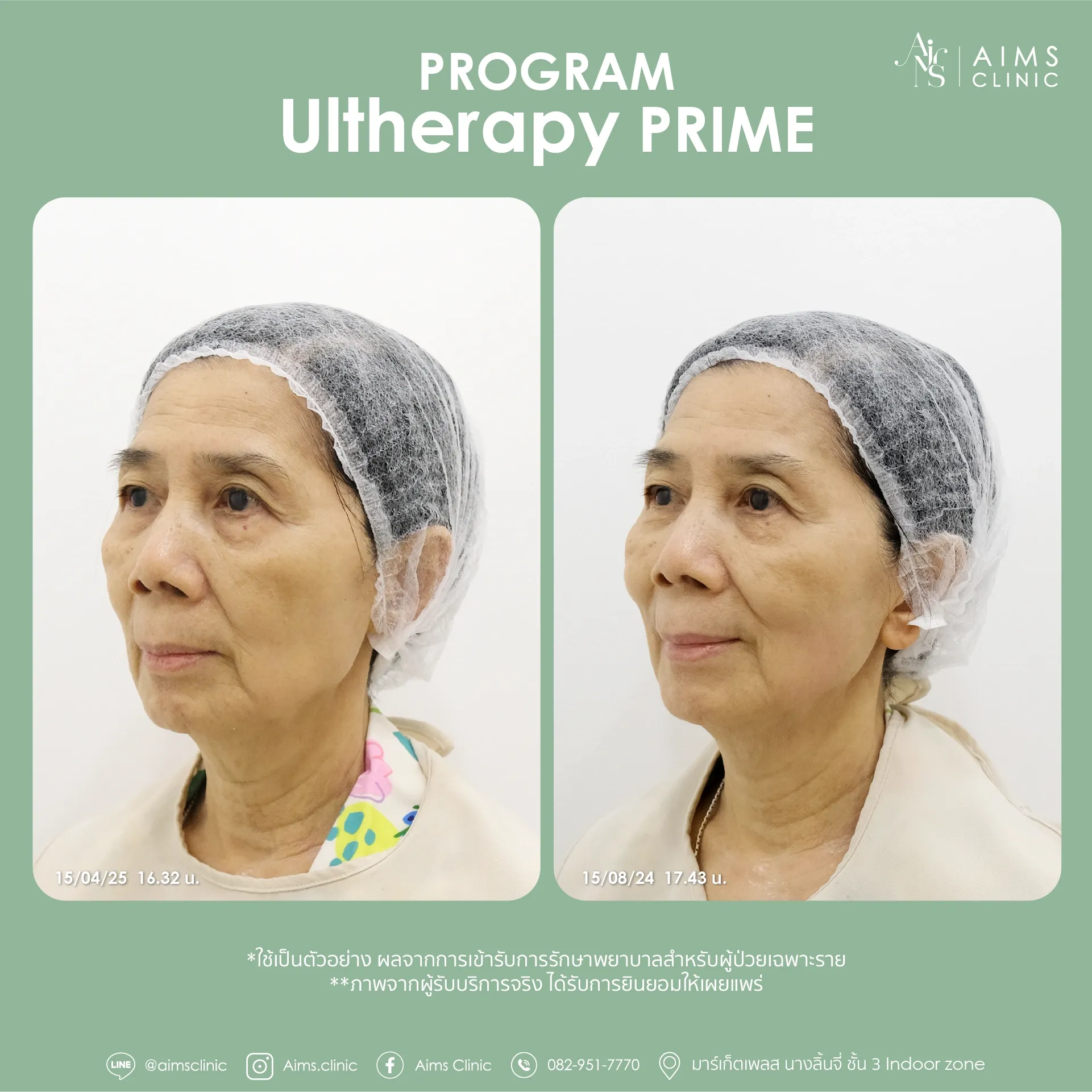 Before and after photos: โปรแกรม Ultherapy Prime
