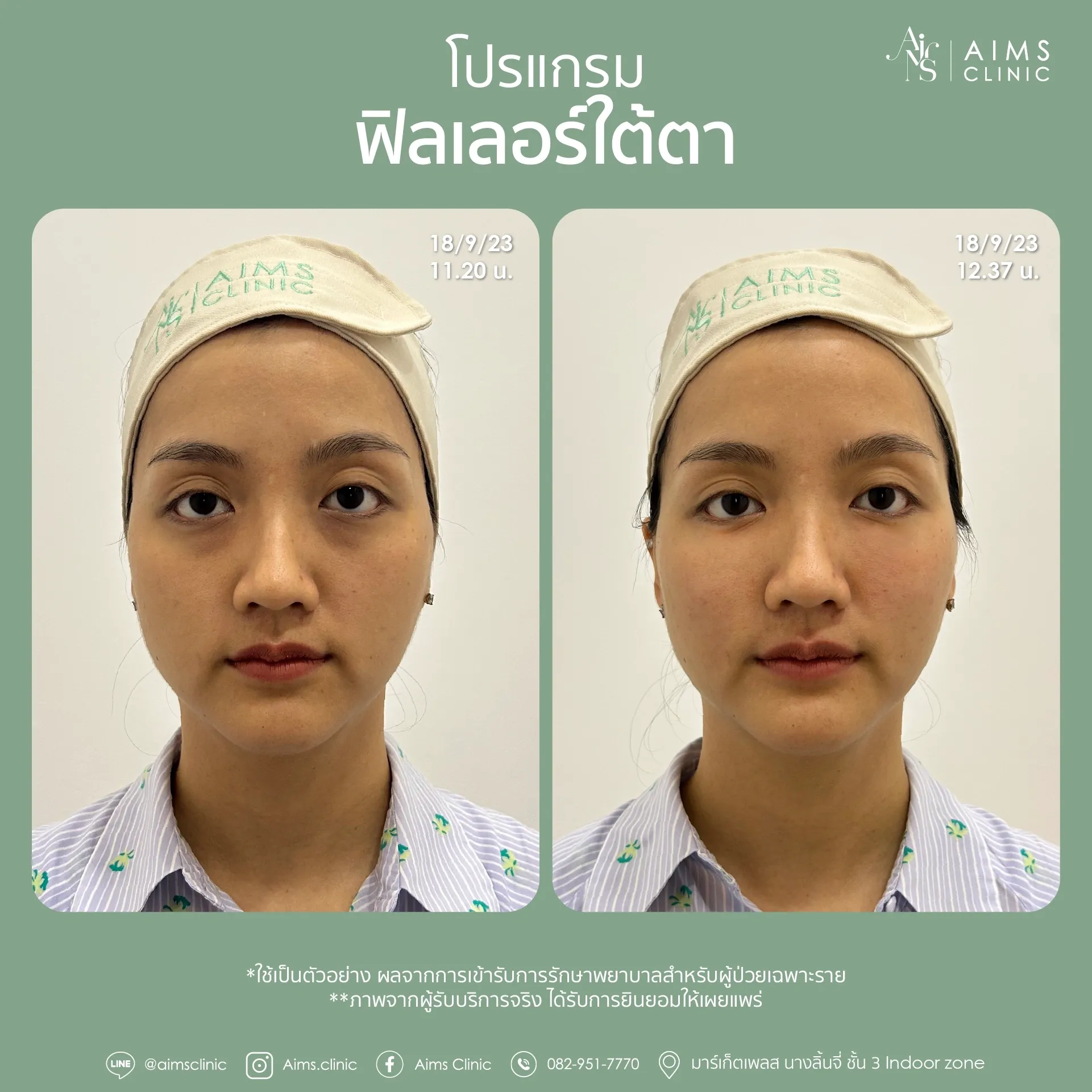 Before and after photos: โปรแกรม Filler