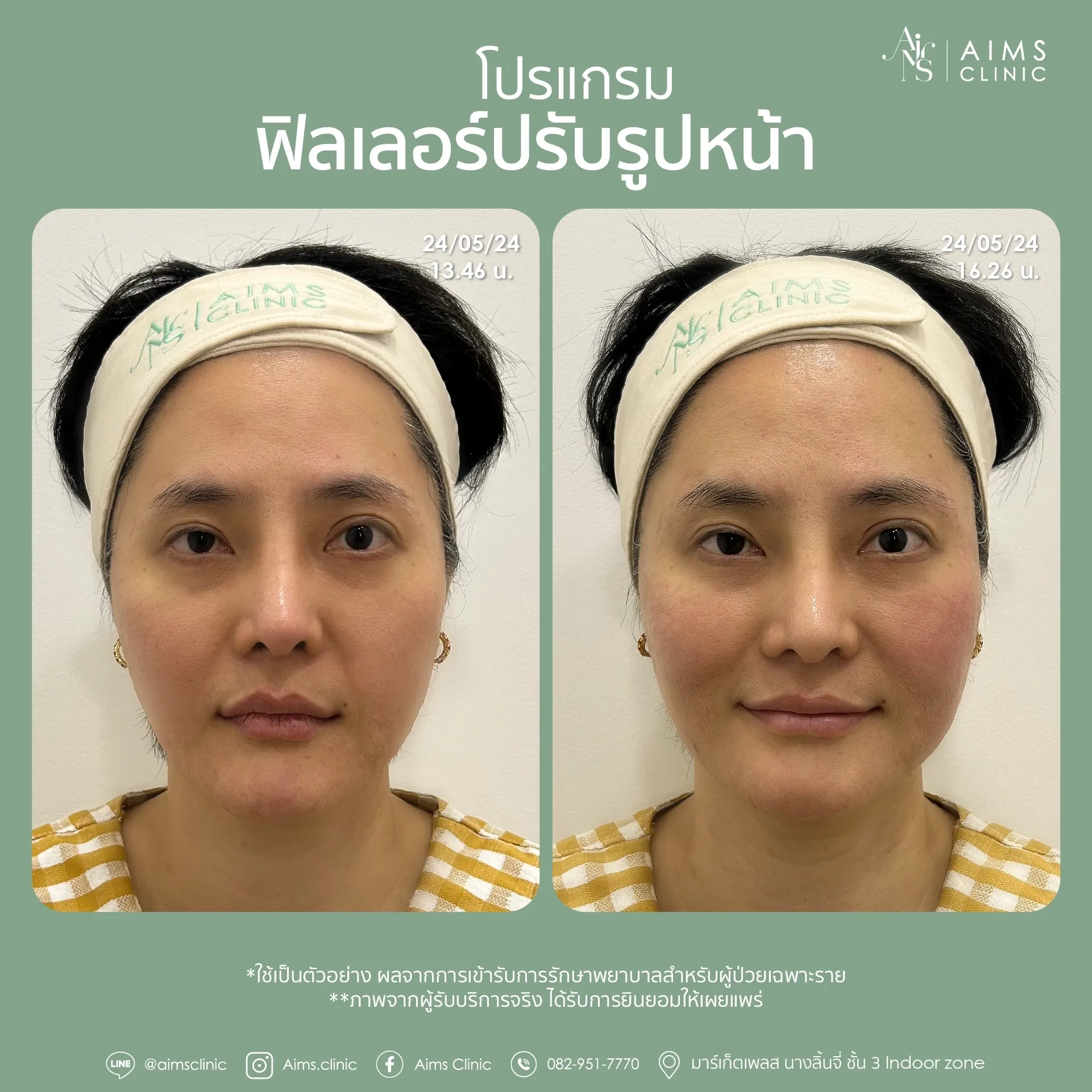 Before and after photos: โปรแกรม Filler