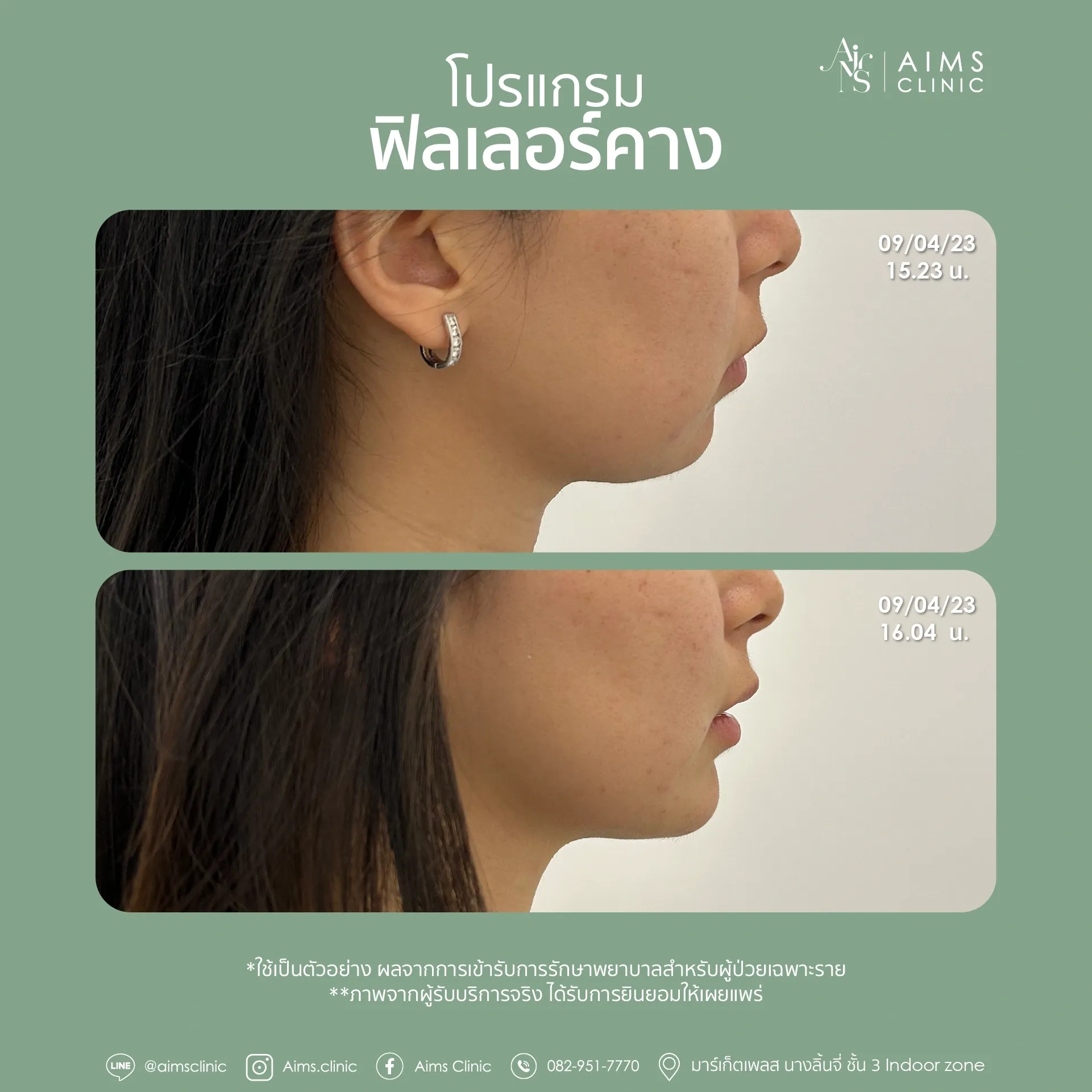 Before and after photos: โปรแกรม Filler