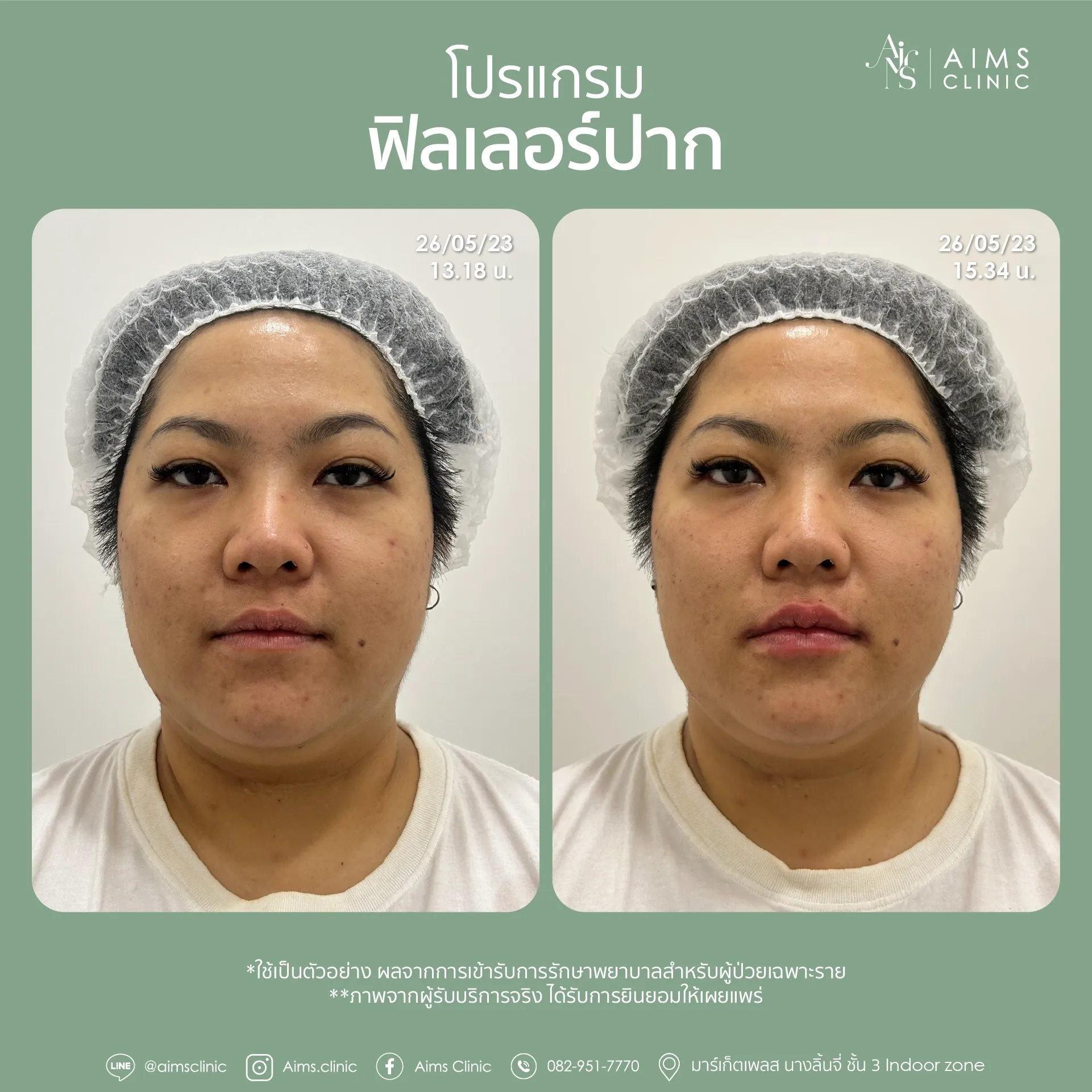 Before and after photos: โปรแกรม Filler