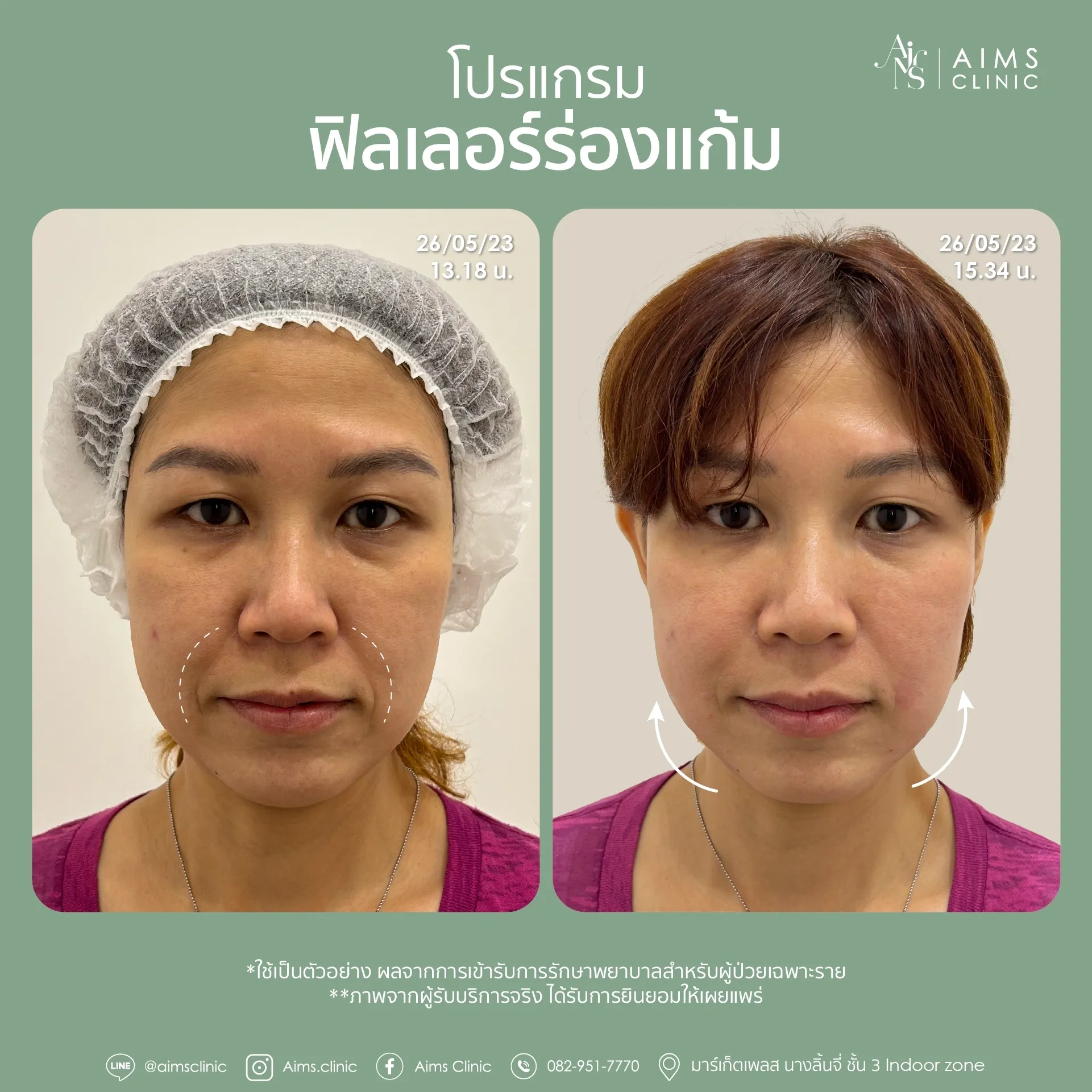Before and after photos: โปรแกรม Filler