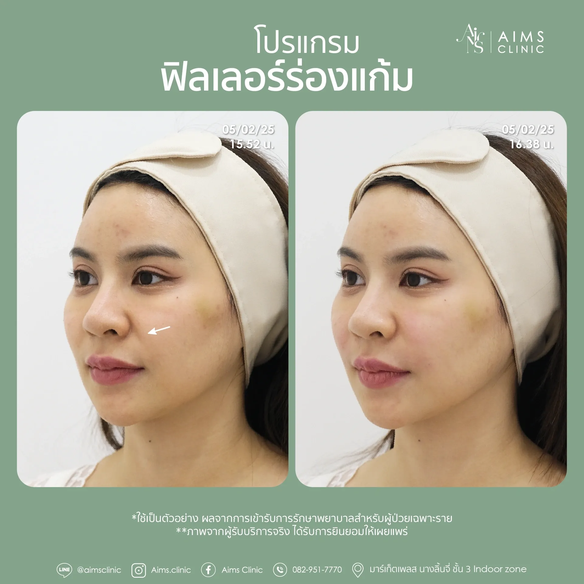 Before and after photos: โปรแกรม Filler