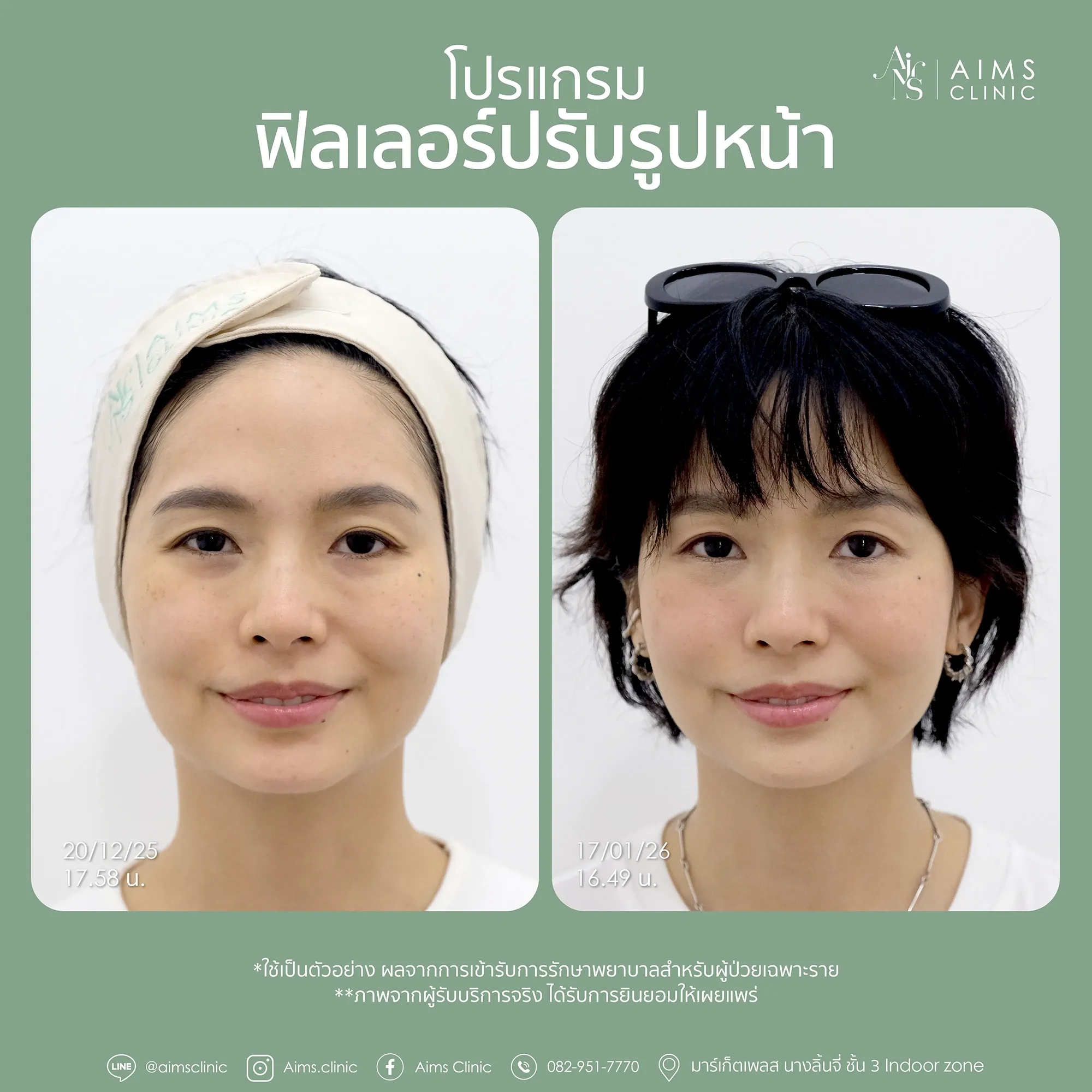 ภาพเปรียบเทียบก่อนและหลังรับบริการโปรแกรม Filler