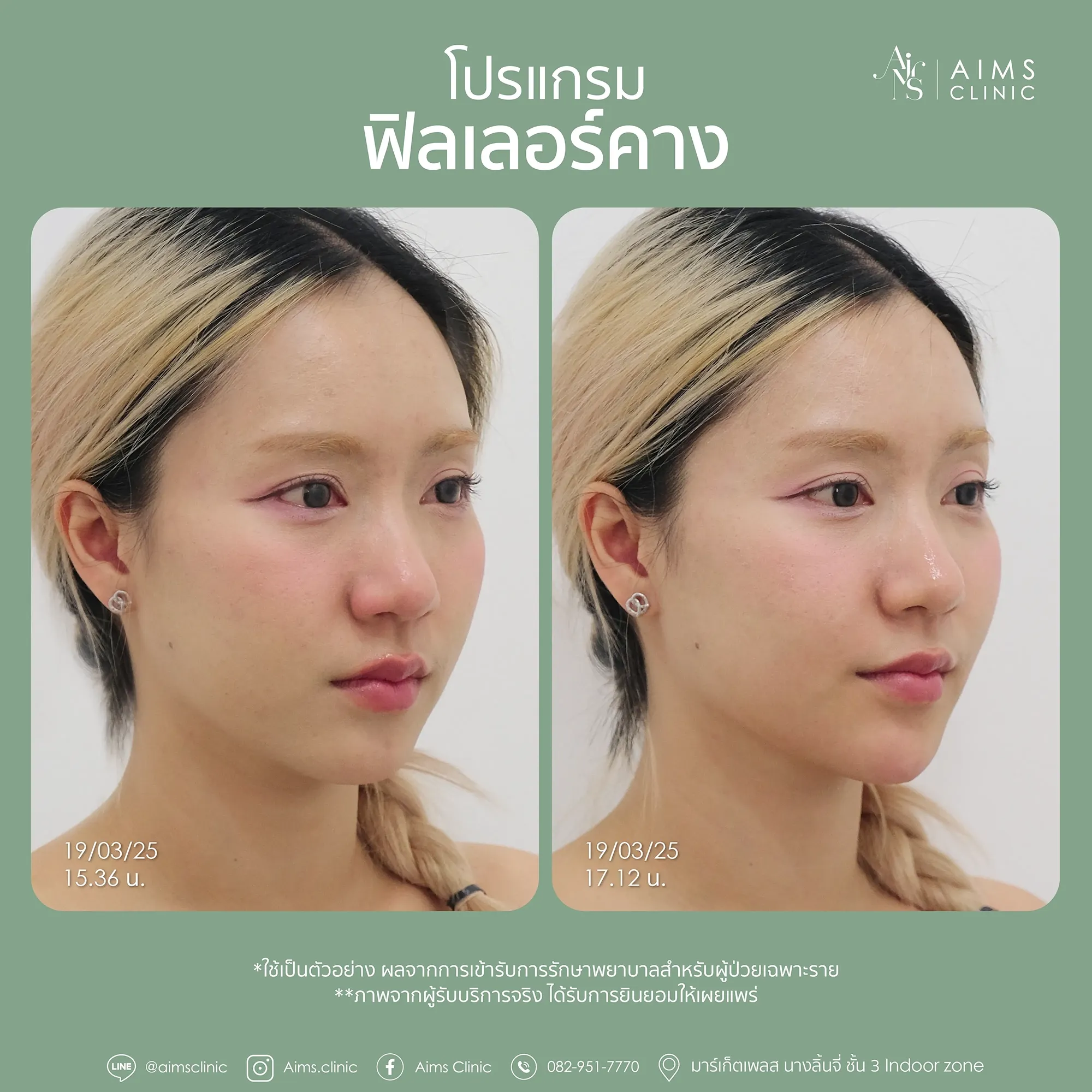 Before and after photos: โปรแกรม Filler