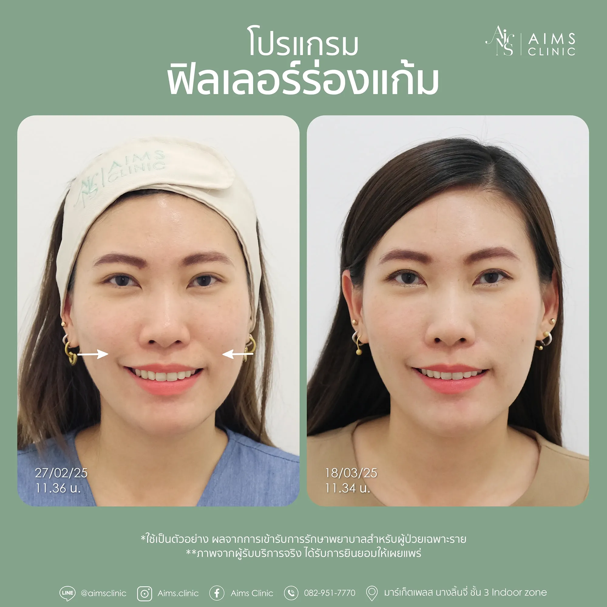 Before and after photos: โปรแกรม Filler