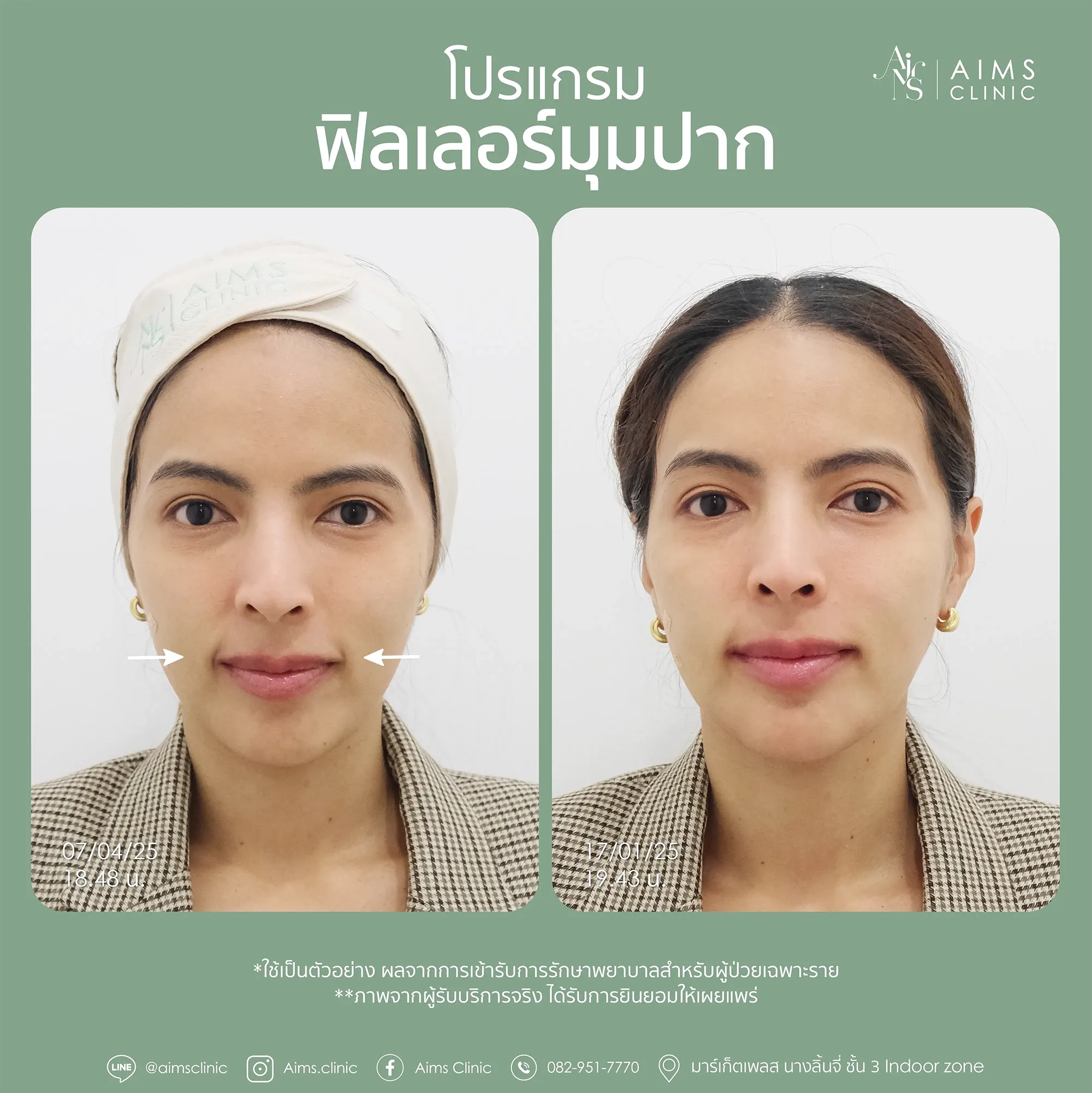Before and after photos: โปรแกรม Filler