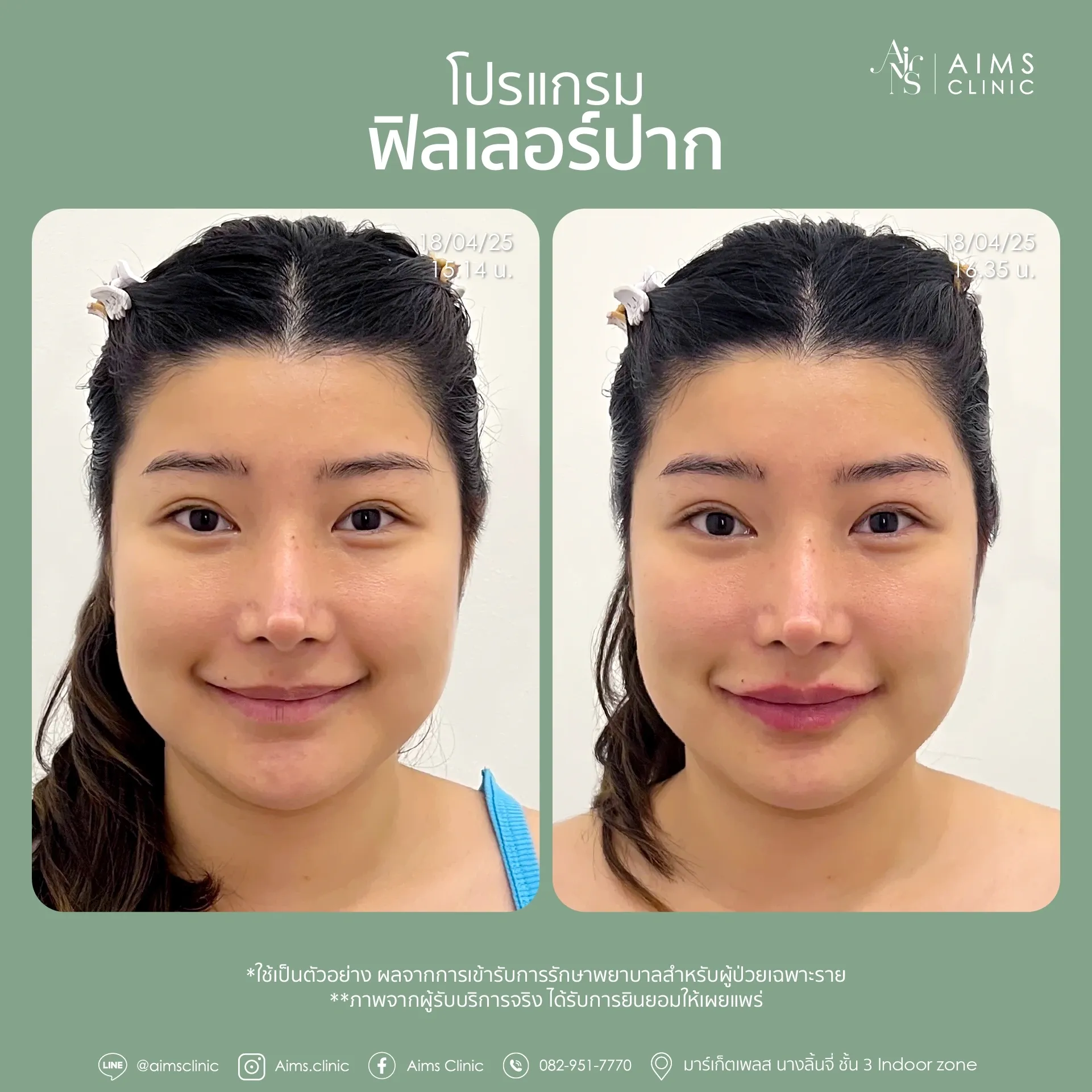 Before and after photos: โปรแกรม Filler
