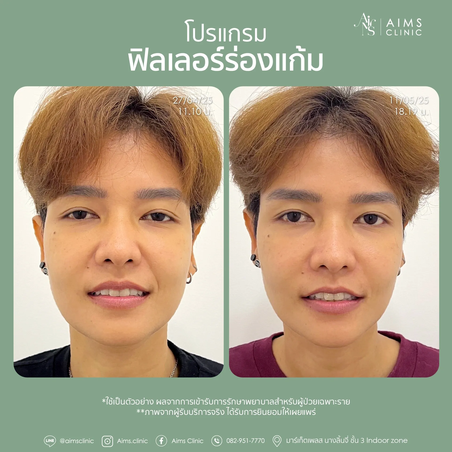 Before and after photos: โปรแกรม Filler