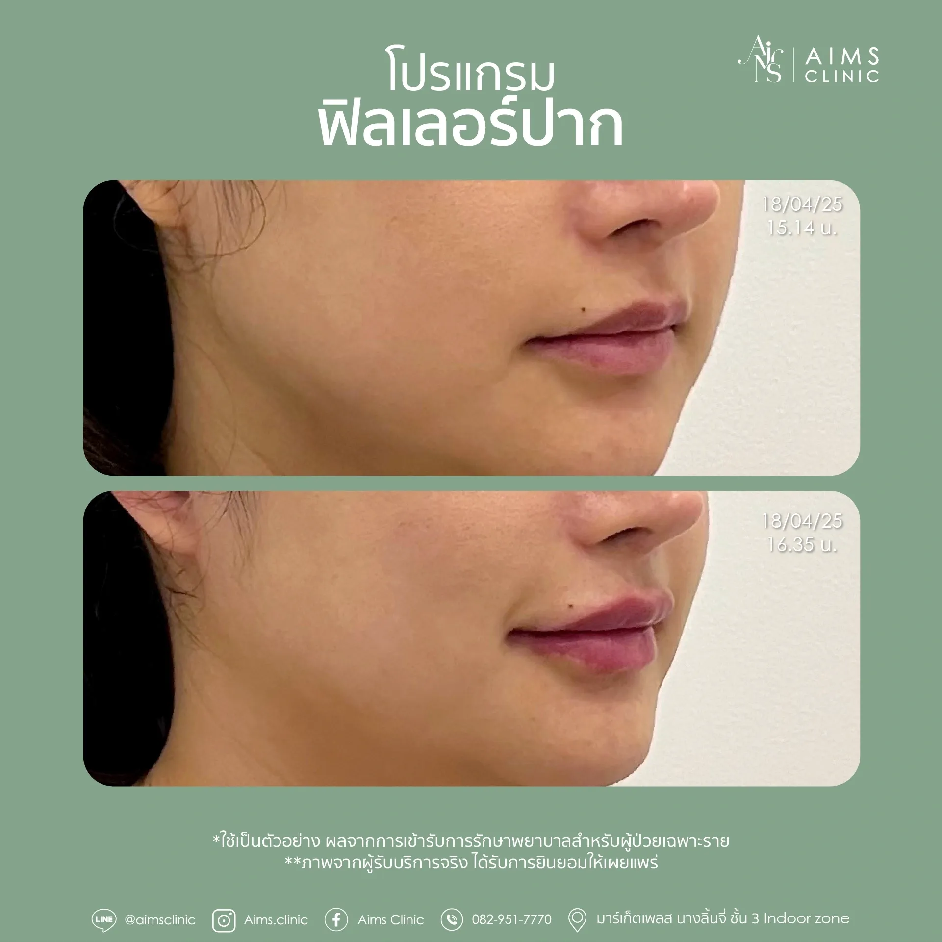 Before and after photos: โปรแกรม Filler