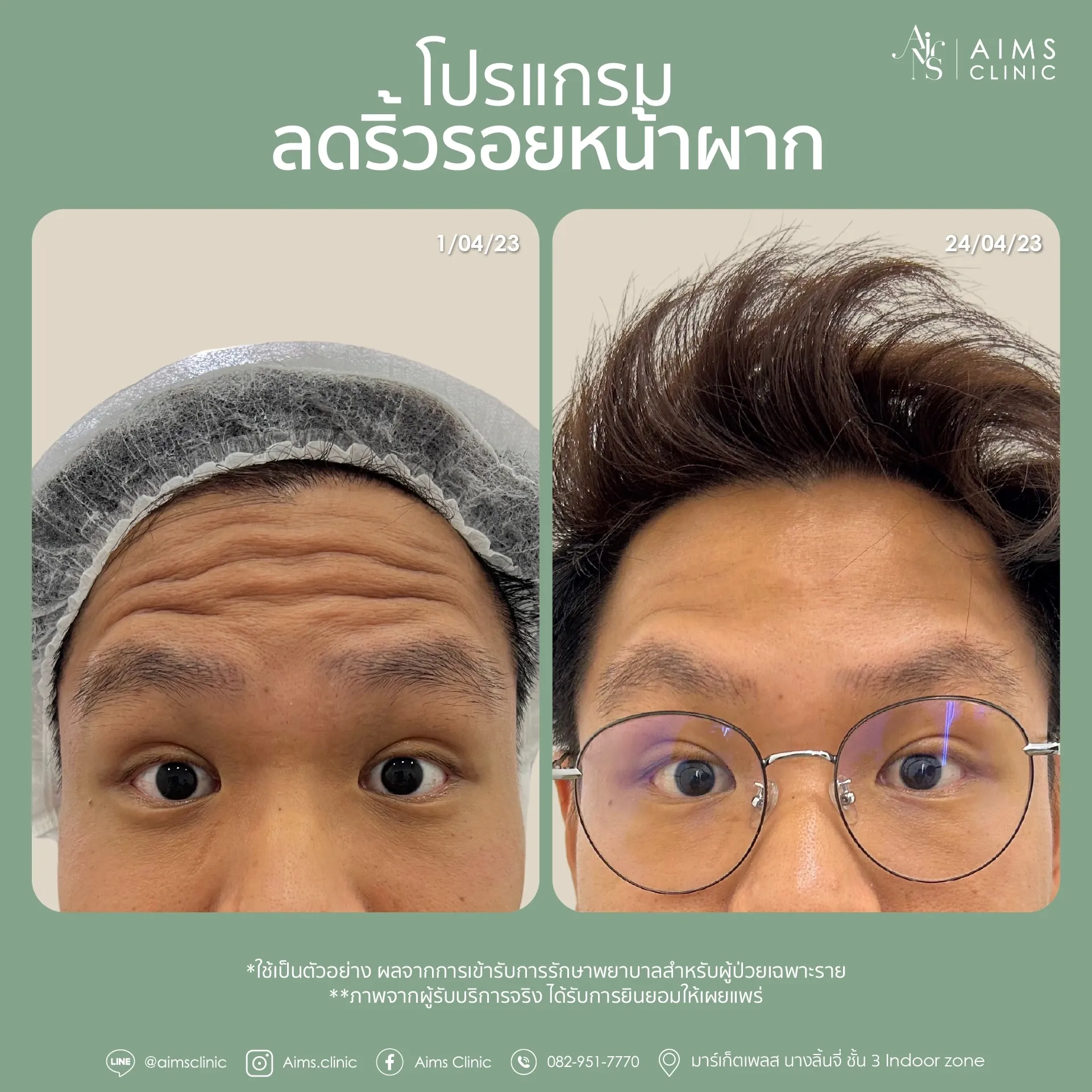 ภาพเปรียบเทียบก่อนและหลังรับบริการโปรแกรมลดริ้วรอย