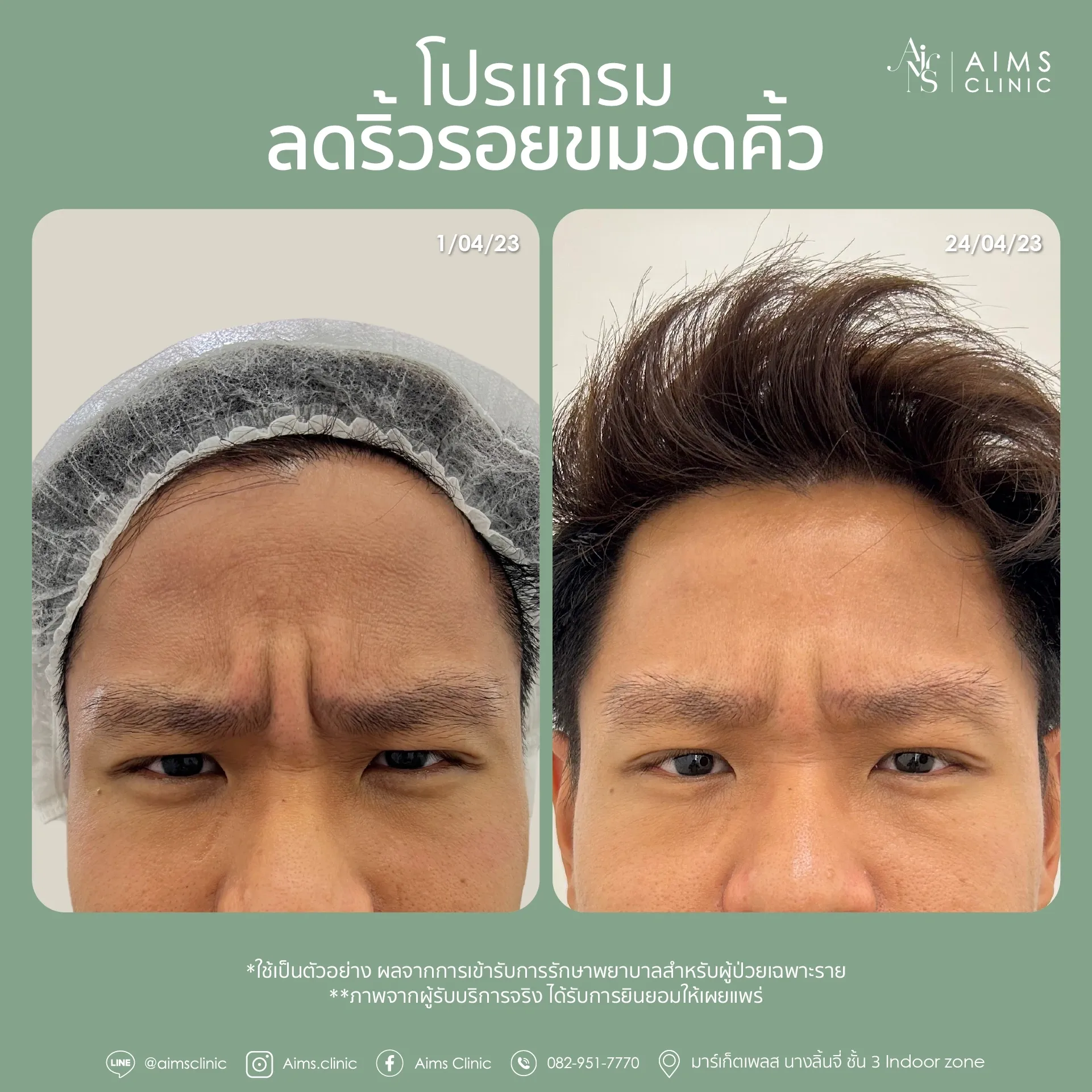 ภาพเปรียบเทียบก่อนและหลังรับบริการโปรแกรมลดริ้วรอย