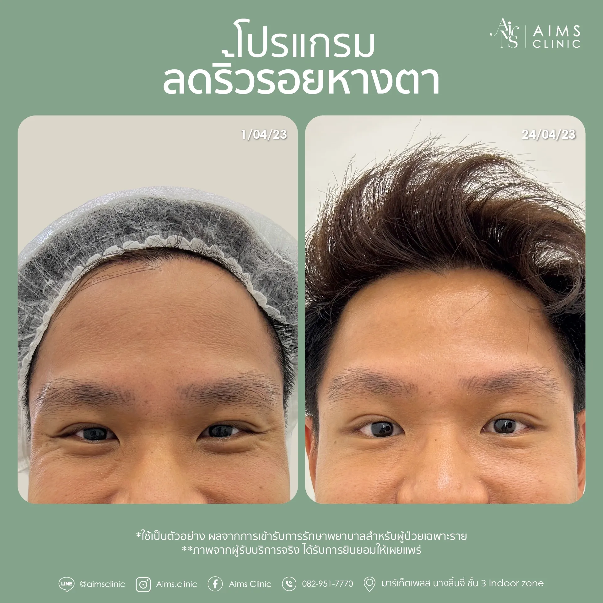 ภาพเปรียบเทียบก่อนและหลังรับบริการโปรแกรมลดริ้วรอย