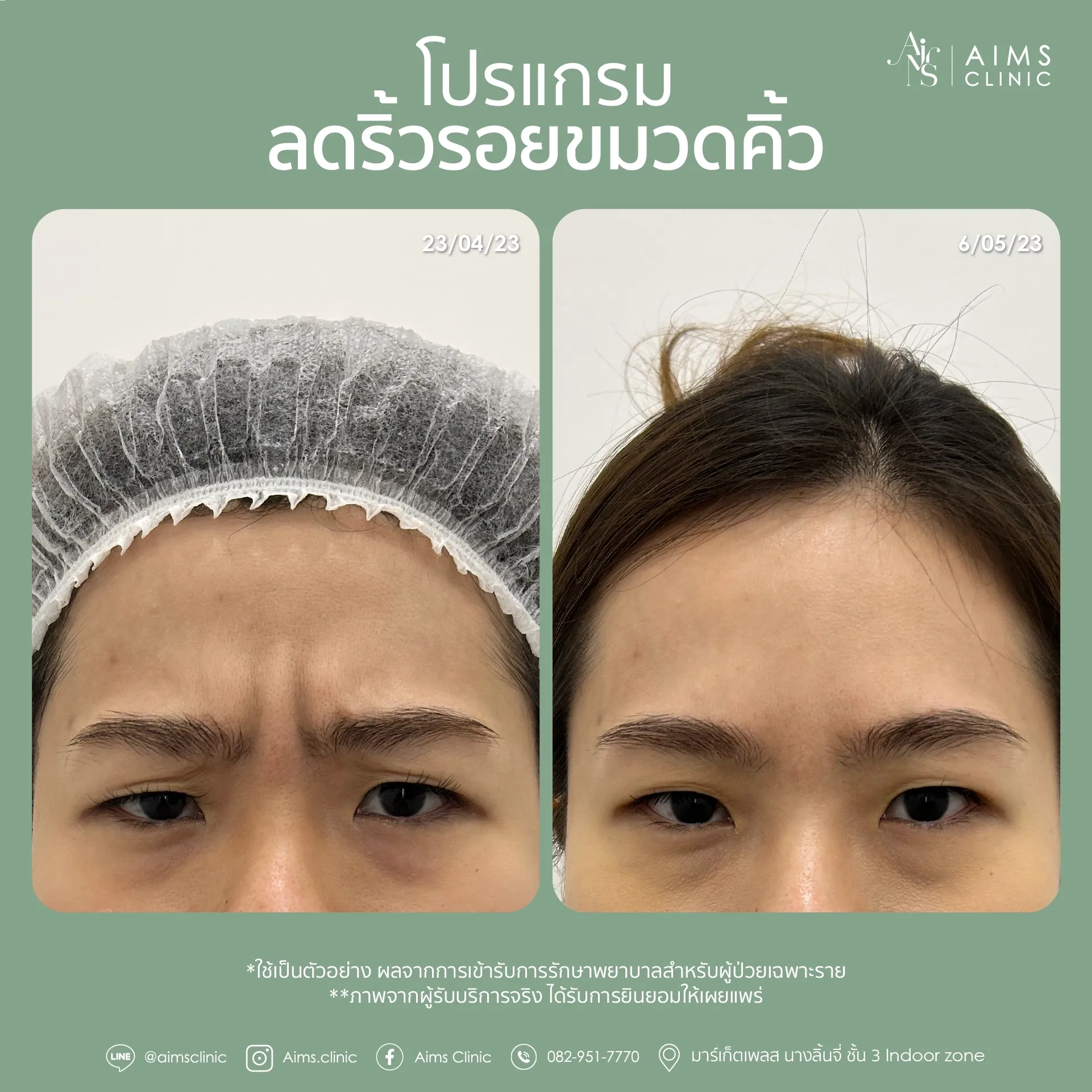 ภาพเปรียบเทียบก่อนและหลังรับบริการโปรแกรมลดริ้วรอย