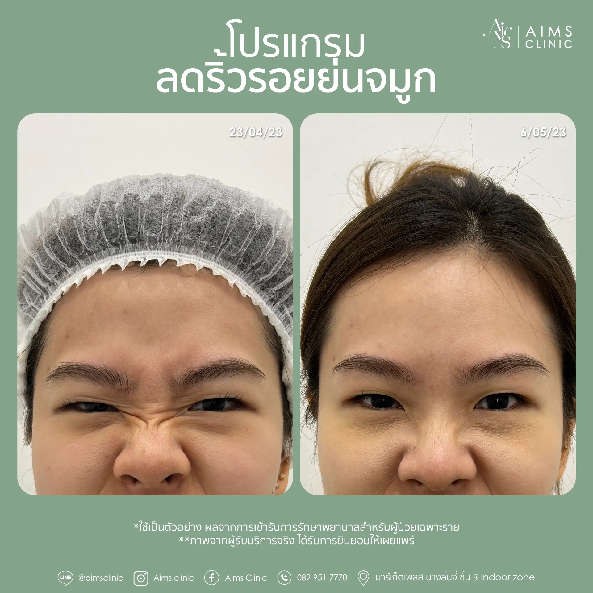 ภาพเปรียบเทียบก่อนและหลังรับบริการโปรแกรมลดริ้วรอย