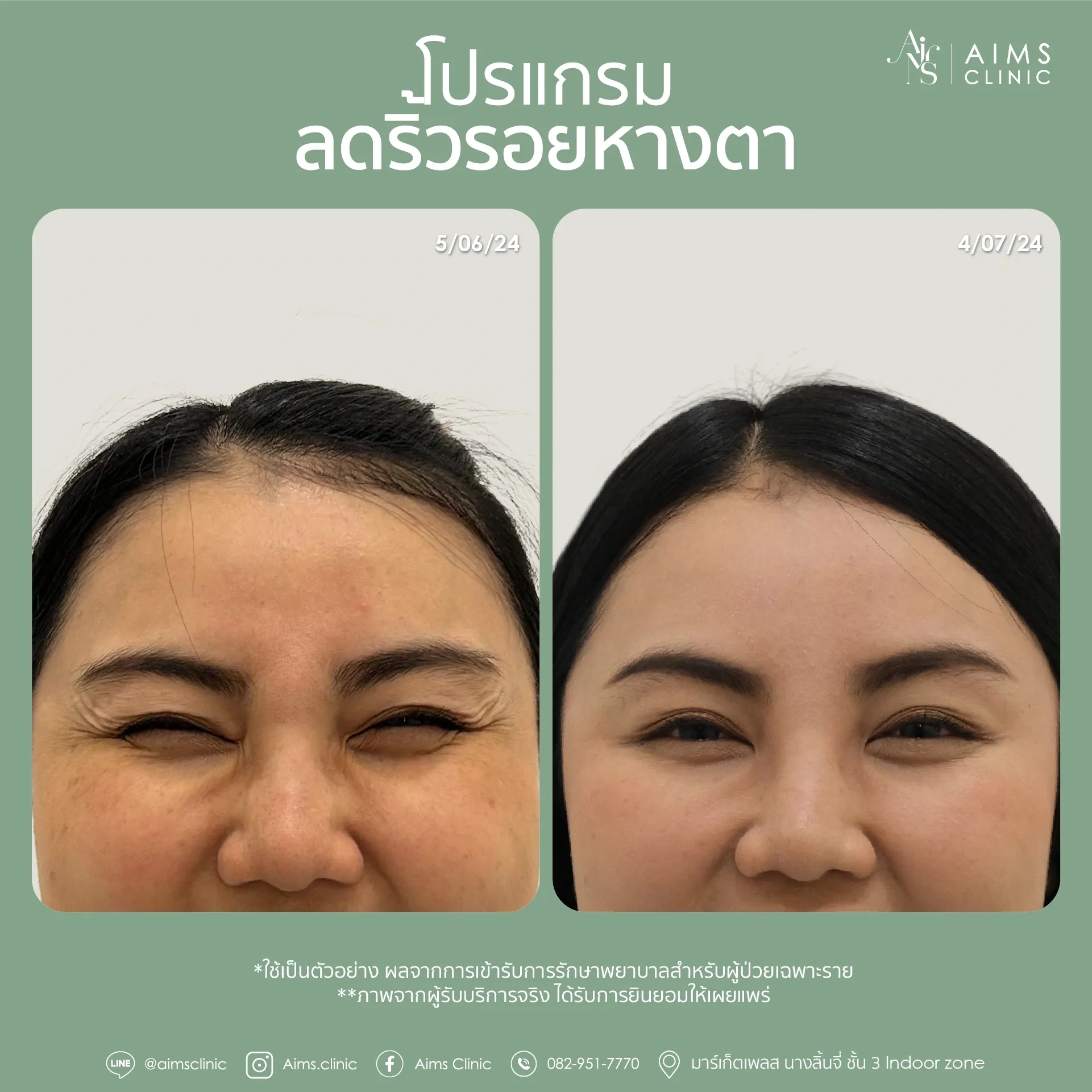 ภาพเปรียบเทียบก่อนและหลังรับบริการโปรแกรมลดริ้วรอย