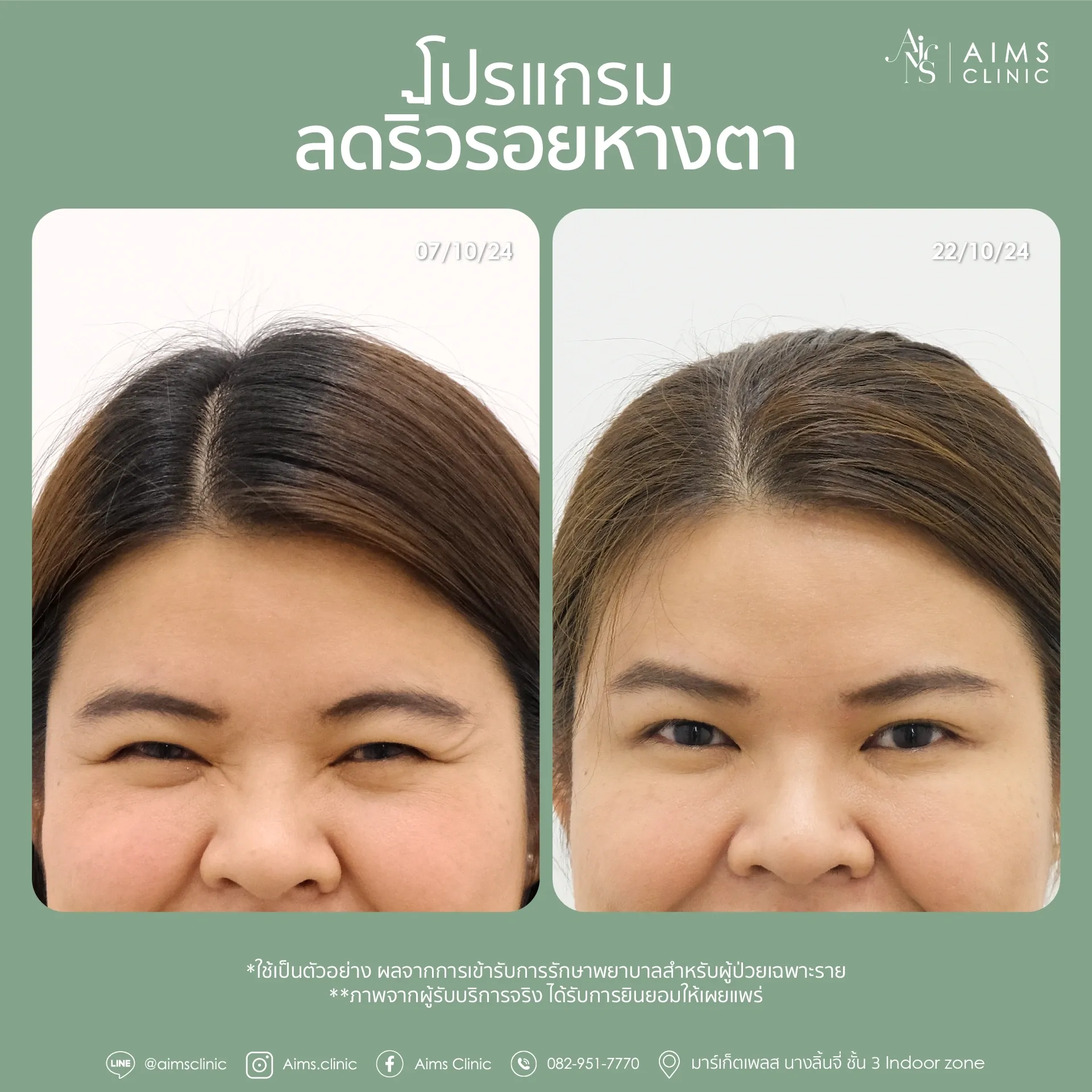 ภาพเปรียบเทียบก่อนและหลังรับบริการโปรแกรมลดริ้วรอย
