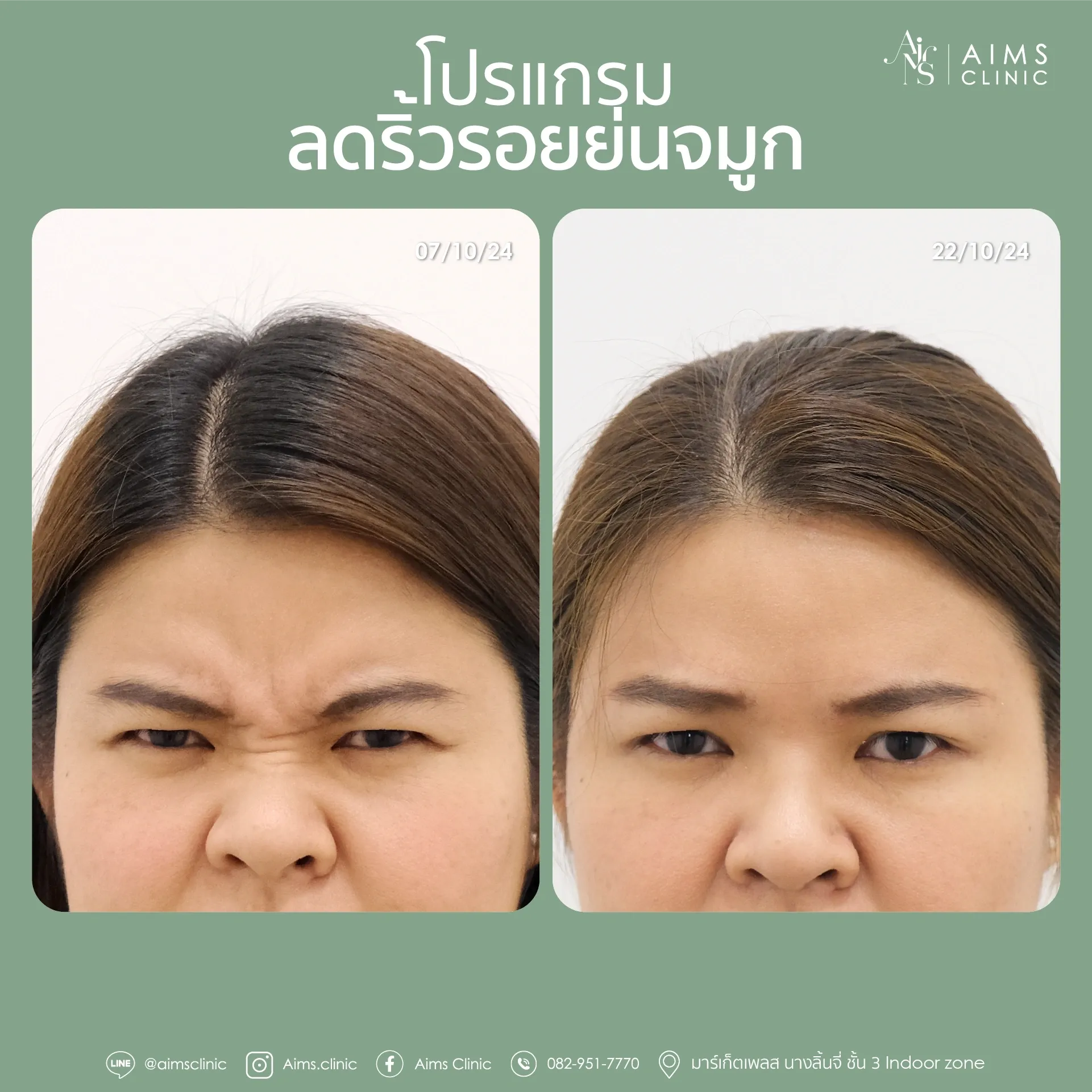 ภาพเปรียบเทียบก่อนและหลังรับบริการโปรแกรมลดริ้วรอย