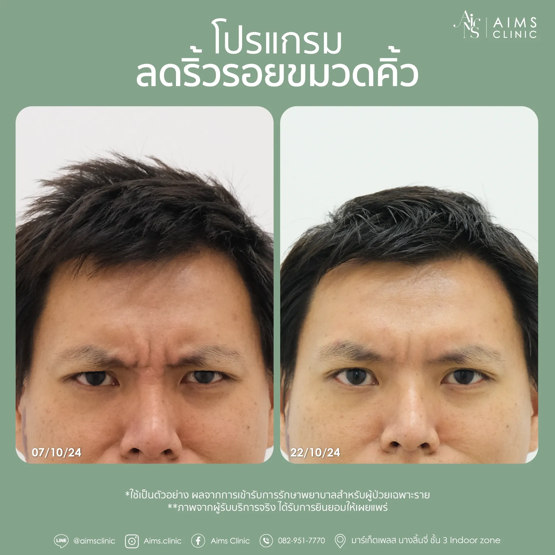 ภาพเปรียบเทียบก่อนและหลังรับบริการโปรแกรมลดริ้วรอย