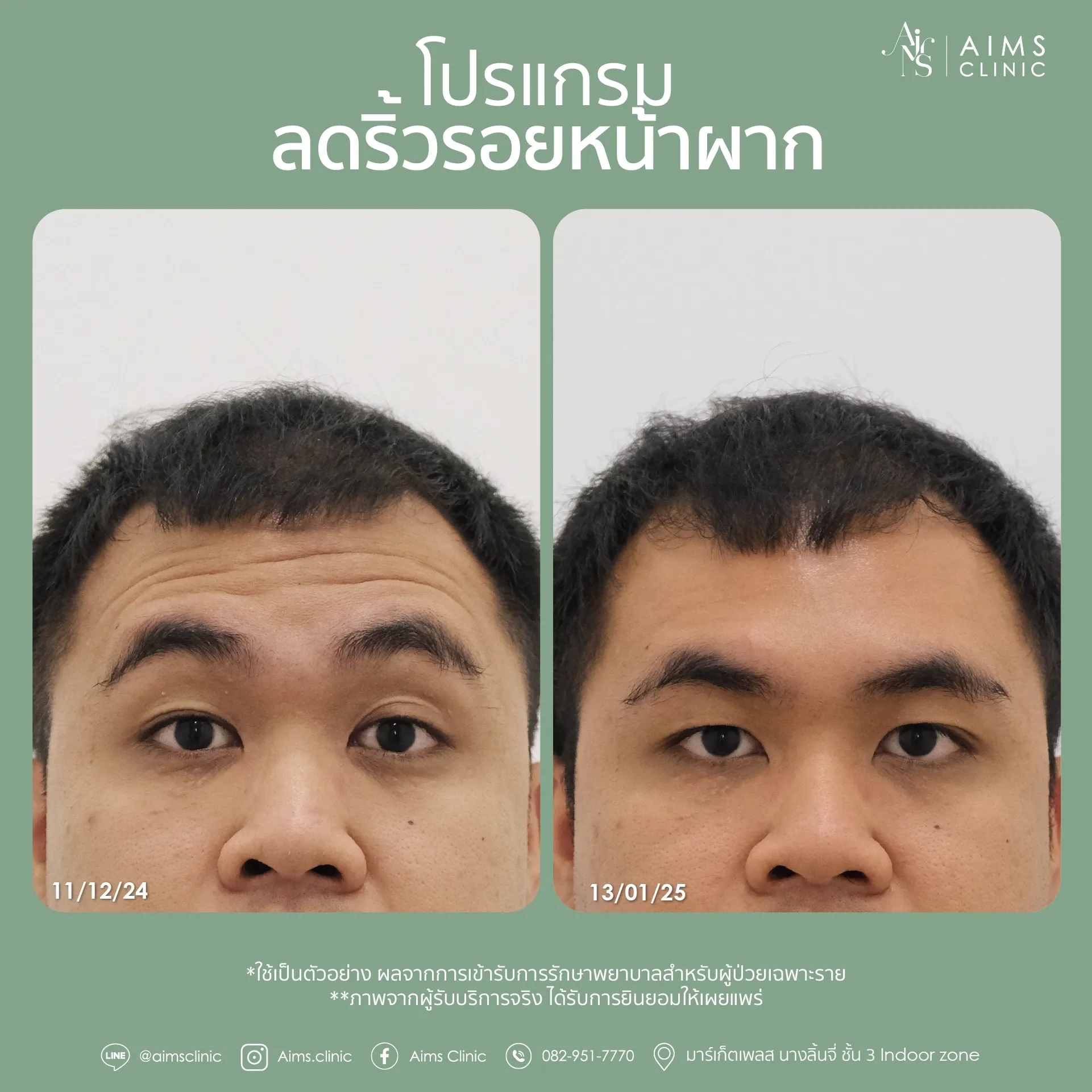 ภาพเปรียบเทียบก่อนและหลังรับบริการโปรแกรมลดริ้วรอย